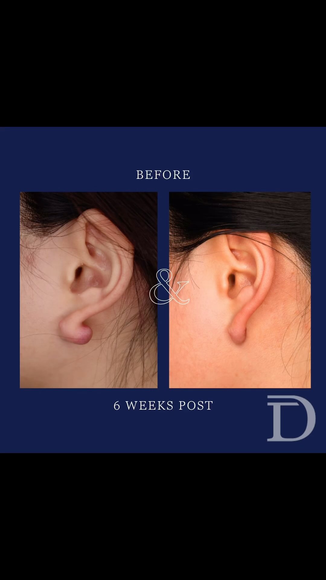 Bilateral Ear Lobe Intra-Lesional Excision of Keloid Scar + Steroid Injection
1. Pre Surgery 
2. 6 Weeks Post 
- Scars take 12 - 18 months to mature/ fade
- After the excision surgery, steroid injections are also completed in the outpatient rooms 4-6 weeks apart, approximately 4-5 times, to help flatten/ prevent keloid scar from re-forming. 
Surgery Performed by Dr Duncan Taylor (MED0001883464) Specialist Plastic & Reconstructive Surgeon.
🔹 Outcomes achieved in these photos are only relevant to this patient and do not necessarily reflect the results other patients may experience.
🔹There are inherent risks associated with any surgical or invasive procedures. The recovery period varies based on the specific procedure, and individual outcomes will differ.
🔹More information about risks and recovery for each procedure is available on our website www.drduncantaylor.com.au, on the procedure information sheets.
🔹We recommend getting a second opinion from a qualified health practitioner before proceeding.
🔹 This patient gave photo consent. 
#perthplasticsurgeon #plasticsurgeonperth #perthplasticsurgery #plasticsurgeryperth #earkeloids #scarrevisionsurgery #intralesionalexcision #keloidsurgeryperth #perthkeloidtreatment