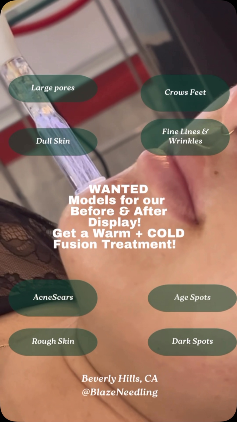 🌟 MODELS WANTED 🌟
Experience our non-invasive Warm Fusion + Cold Plasma Ideal for addressing fine lines, wrinkles, dull skin, and large pores. Suitable for skin types 1-5.
✨ Join our transformation journey!
Please note:
- Cannot be pregnant or breastfeeding.
- Minimal downtime; expect a sunburn feeling on day one and freckled-like appearance for about a week.
Not all submissions will be accepted. Submit a picture of your skin and your weekly availability.
You must be comfortable with video and photos being posted online and in our studio.
Send email submissions to info@blazeneedling.com
#Warmplasma #warmfusion #coldplasma