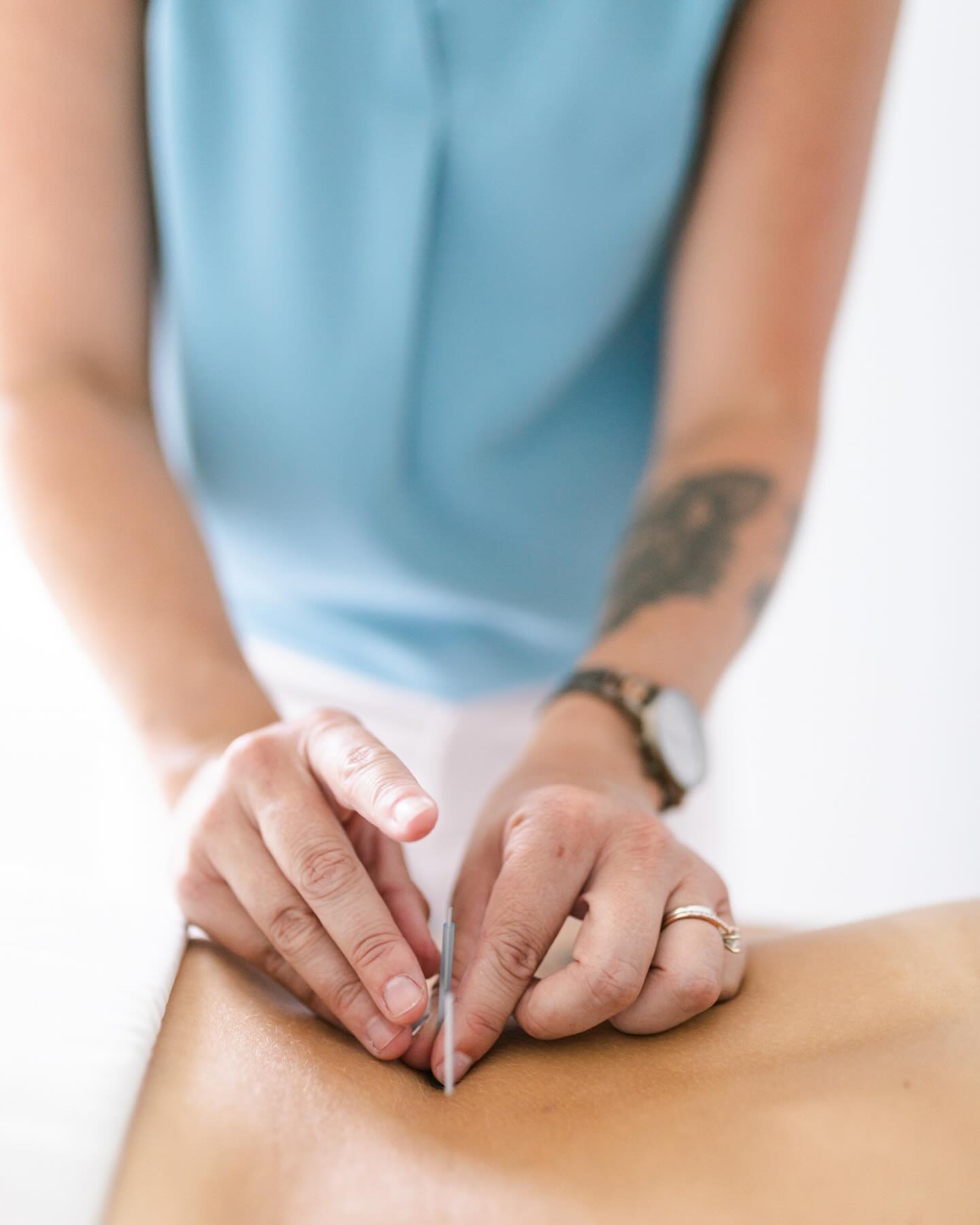 If you’re dealing with pain, consider seeing an acupuncturist—not just someone offering “dry needling.”
Here’s why:
💡 Acupuncture takes a biopsychosocial approach. Pain isn’t always about tissue damage. Emotions, stress, diet, sleep, and your nervous system all play a role.
💡 We use techniques like ashi or trigger point needling (the original dry needling), but we go beyond that to support your body and mind.
💡 Acupuncture helps address:
✨ Emotional connections to pain. In Chinese Medicine, our emotions can be the root of our pain. Think of tension in the neck and shoulders when you’re stressed. Or a backache when you’re scared and bracing.
✨ Calms the nervous system and reduce stress. You can’t heal optimally if you’re always in a sympathetic state.
✨ Improve digestion. It’s hard to heal if we aren’t digesting well. In Chinese medicine, digestion is connected to the health of our muscles. We are what we eat. Healthy digestion promotes the production of blood that nourishes and heals the muscles and provides the building blocks. It also helps us clear out waste.
✨ Enhance sleep to help you recover and heal
Acupuncture treats the whole person—your body, mind, and spirit.
Let’s get to the root of your pain. Not just a quick fix.
#AcupunctureWorks #PainRelief #HolisticHealing #StressRelief #NervousSystemCare #Acupuncturist #TriggerPointTherapy #WellnessJourney #SleepSupport #DigestiveHealth #BreatheEasyLiveFully #acupuncture #painrelief #dryneedle #triggerpoints