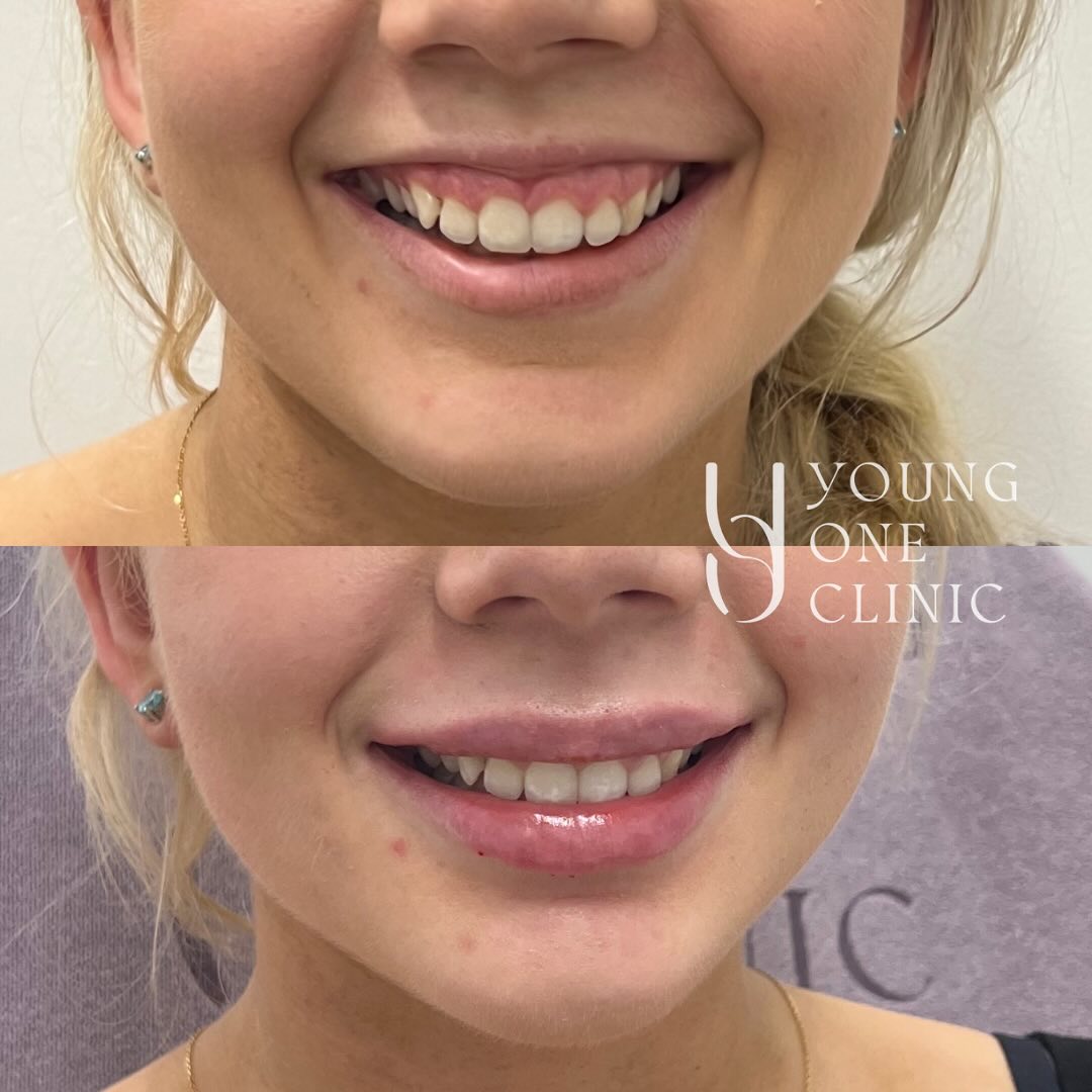 A gummy smile can be beautifully softened with lip treatments. These subtle enhancements work together to:
✨Reduce gum exposure
✨Accentuate the natural curve of your lips
✨Create a harmonious, confident smile
Thank you to all my patients who trust and let me post your results ❤️ I‘m so grateful!
Welcome to book in a consultation to know more about:
- Lips enhancement
- under-eye rejuvenation
- Facial balancing/ contouring
- Wrinkle reduction
- Face slimming
- Bruxism/ teeth clenching
Disclaimer: All images used with consent. Individual results vary. Always seek advice from a qualified medical professional. A thorough consult is required for suitability, risks, side effects, procedure, options and aftercare. Any cosmetic or invasive procedure carries risk.
#gummysmile #brisbane #lips #brisbanelips #brisbanegummysmile #naturalresults #smile