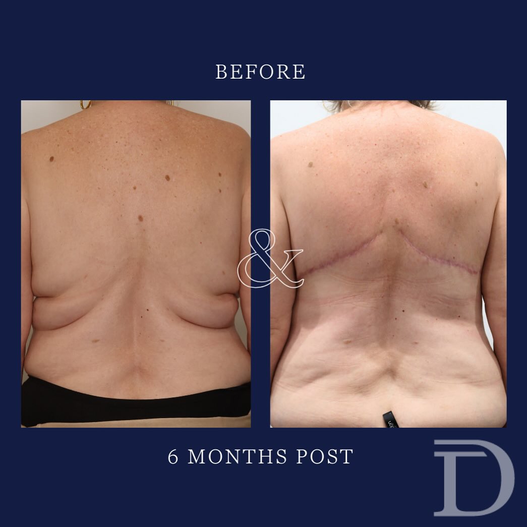 Upper Back Lipectomy/ Lift 
1. Pre Surgery 
2. 6 Months Post 
- Scars take 12 - 18 months to mature/ fade
Surgery Performed by Dr Duncan Taylor (MED0001883464) Specialist Plastic & Reconstructive Surgeon.
🔹 Outcomes achieved in these photos are only relevant to this patient and do not necessarily reflect the results other patients may experience.
🔹There are inherent risks associated with any surgical or invasive procedures. The recovery period varies based on the specific procedure, and individual outcomes will differ.
🔹More information about risks and recovery for each procedure is available on our website www.drduncantaylor.com.au, on the procedure information sheets.
🔹We recommend getting a second opinion from a qualified health practitioner before proceeding.
🔹 This patient gave photo consent. 
#perthplasticsurgeon #plasticsurgeonperth #plasticsurgeryperth #perthplasticsurgery #bodycontouringperth #perthbodycontouring #backliftsurgery #specialistplasticsurgeon #cosmeticsurgeryperth #perthcosmeticsurgery