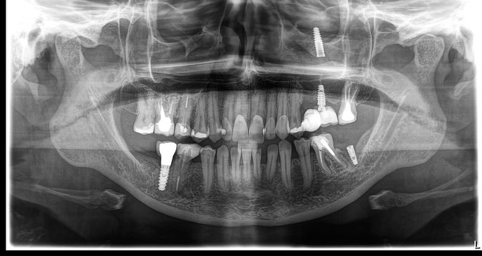 🚨 Erros Graves em Implantodontia: Implantes Dentro do Seio Maxilar! 🚨
A implantodontia é uma especialidade que exige precisão e planejamento cuidadoso. Infelizmente, erros podem acontecer – e alguns deles são verdadeiras tragédias! 😨
Um dos piores erros é a perfuração do assoalho do seio maxilar, levando o implante a migrar para dentro da cavidade sinusal. Isso pode causar:
⚠ Infecções severas (sinusite crônica de difícil controle)
⚠ Dor intensa e desconforto constante
⚠ Necessidade de remoção cirúrgica do implante por via endoscópica ou cirurgia maior
⚠ Falha do tratamento e necessidade de enxertos ósseos complexos
Esse tipo de erro geralmente acontece por planejamento inadequado, falta de tomografia computadorizada ou desconhecimento da anatomia do paciente.
Quer evitar complicações?
✅ Sempre exija um planejamento digital completo
✅ Procure um profissional experiente em implantodontia
✅ Questione sobre exames pré-operatórios e planejamento guiado
Essa é só uma das iatrogenias graves que podem ocorrer em implantodontia! Quer saber mais? Fique ligado para os próximos posts!
📌 Marque um amigo dentista para alertá-lo sobre esse risco!
#Implantodontia #ErroOdontológico #SeioMaxilar #ImplanteDentário #Odontologia #CTBMF #bucomaxilomaterdei