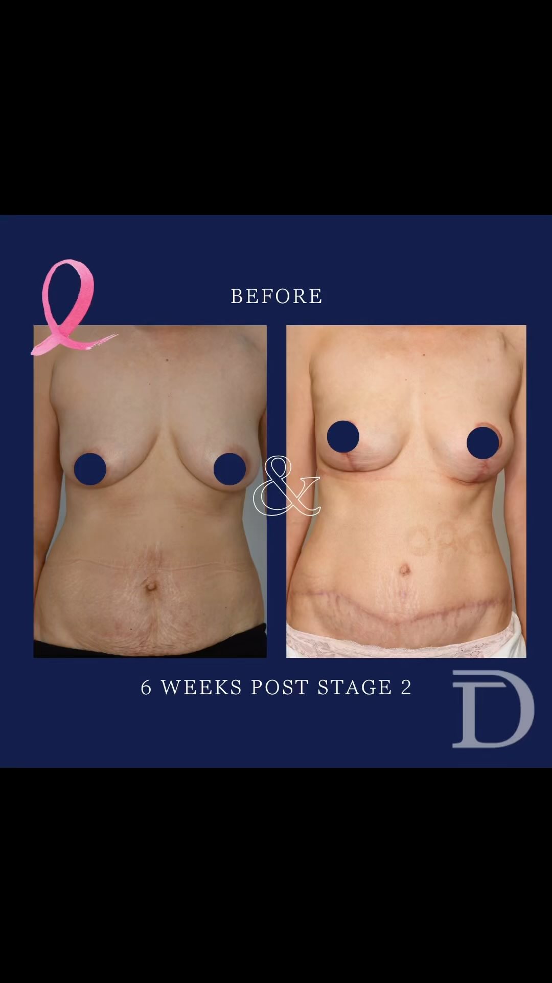 Right Nipple Sparing Mastectomy + Immediate DIEP Breast Reconstruction 
1. Pre Surgery 
2. 6 Weeks Post Revision Surgery 
- Scars take 12 - 18 months to mature/ fade
- Surgery 1. for this patient = Right Mastectomy + Immediate DIEP Breast Reconstruction
- Surgery 2. for this patient = Revision of Right Breast DIEP + Left Breast Mastopexy (Lift)
Surgery Performed by Dr Duncan Taylor (MED0001883464) Specialist Plastic & Reconstructive Surgeon.
🔹 Outcomes achieved in these photos are only relevant to this patient and do not necessarily reflect the results other patients may experience.
🔹There are inherent risks associated with any surgical or invasive procedures. The recovery period varies based on the specific procedure, and individual outcomes will differ.
🔹More information about risks and recovery for each procedure is available on our website www.drduncantaylor.com.au, on the procedure information sheets.
🔹We recommend getting a second opinion from a qualified health practitioner before proceeding.
🔹 This patient gave photo consent. 
#unilateralmastectomy #unilateralbreastreconstruction #unilateraldiepflap #nipplesparingmastectomy #mastectomyperth #perthmastectomy #breastcancerperth #perthbreastcancer #plasticsurgeryperth #perthplasticsurgeon #perthplasticsurgery #plasticsurgeonperth #breastreconstructionawareness #microsurgicalbreastreconstruction #diepbreastreconstruction #perthbreastreconstruction #breastreconstructionperth #specialistplasticsurgeon