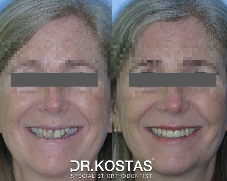 🦷 It's never too late to start orthodontic treatment to achieve the confident and healthier smile you have always wanted! This patient is a great example of excellence in adult orthodontics 😊👌. Contact us today to schedule your initial orthodontic assessment and get you started. #drkostas #adultorthodontics #specialistorthodontist #braces #dublinbraces #smile #smiletransformation #dublinorthodontist #smilemakeover #dublin #orthodontics #straightteeth #teethstraightening #damonbraces #smiletransformation