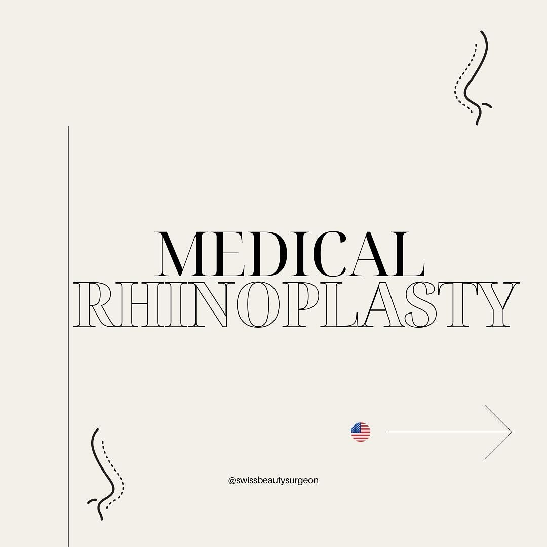 ✨Medical Rhinoplasty: Enhance Your Nose Without Surgery✨
Do you dream of refining or correcting certain aspects of your nose without going under the knife?
Medical rhinoplasty is a quick, non-invasive, and effective solution to reshape your nose using hyaluronic acid injections.
🤔 What is medical rhinoplasty?
It’s an aesthetic technique that allows for correcting small imperfections in the nose, such as:
• Reducing a nasal hump,
• Filling in a dent,
• Lifting the tip of the nose,
• Harmonizing overall symmetry.
✨Benefits of this technique✨:
• Immediate results,
• Painless (thanks to an anesthetic product),
• No recovery time: return to your daily activities right after the session,
• Results are reversible and adjustable.
🫣 Who is it for?
This method is perfect for those looking for a subtle, natural improvement without the constraints of surgery.
👉 At Swissbeautysurgeon, we prioritize a personalized approach to reveal the best version of your profile, while respecting the balance and proportions of your face.
✨Want to learn more? Book a consultation today and see how medical rhinoplasty can gently transform your face.
👉Contact us via private message to reserve your spot!
#MedicalRhinoplasty #HyaluronicAcid #AestheticMedicine #NaturalBeauty #drveber