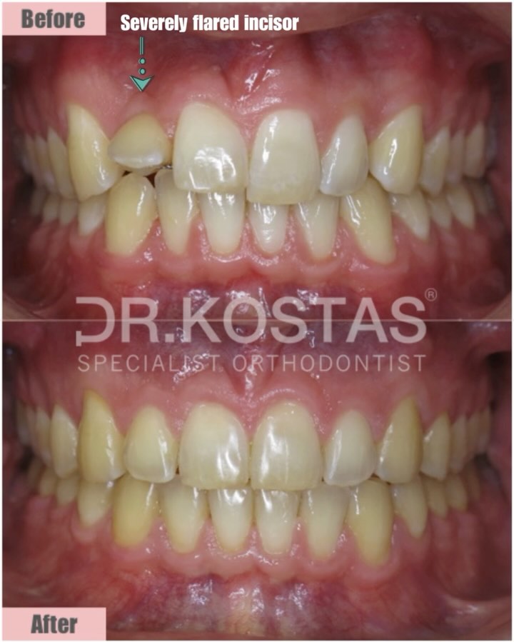 ‼️ Bonded Retainers ‼️
Bonded retainers are orthodontic devices designed to keep teeth in place after braces are removed. If they are not fabricated, installed and monitored by an orthodontic specialist they can lead to significant problems over the long term and this case is a perfect example 🔥 ⚡️
This young man was about to lose one his front teeth because of an “active” bonded retainer. He received orthodontic treatment elsewhere and he came to us concerned about the severely flared lateral incisor.
The orthodontic treatment with Damon-Q braces lasted 16 months and it was carefully planned & precisely executed 💥💯
We were thrilled with the end result and most importantly for managing to save ✅ the patient’s front tooth ✨👏🏻🤩
#drkostas #adultorthodontics
#specialistorthodontist #braces #bondedretainers #dublinorthodontist #smilemakeover #dublin #orthodontics #straightteeth #damonbraces #smiletransformation