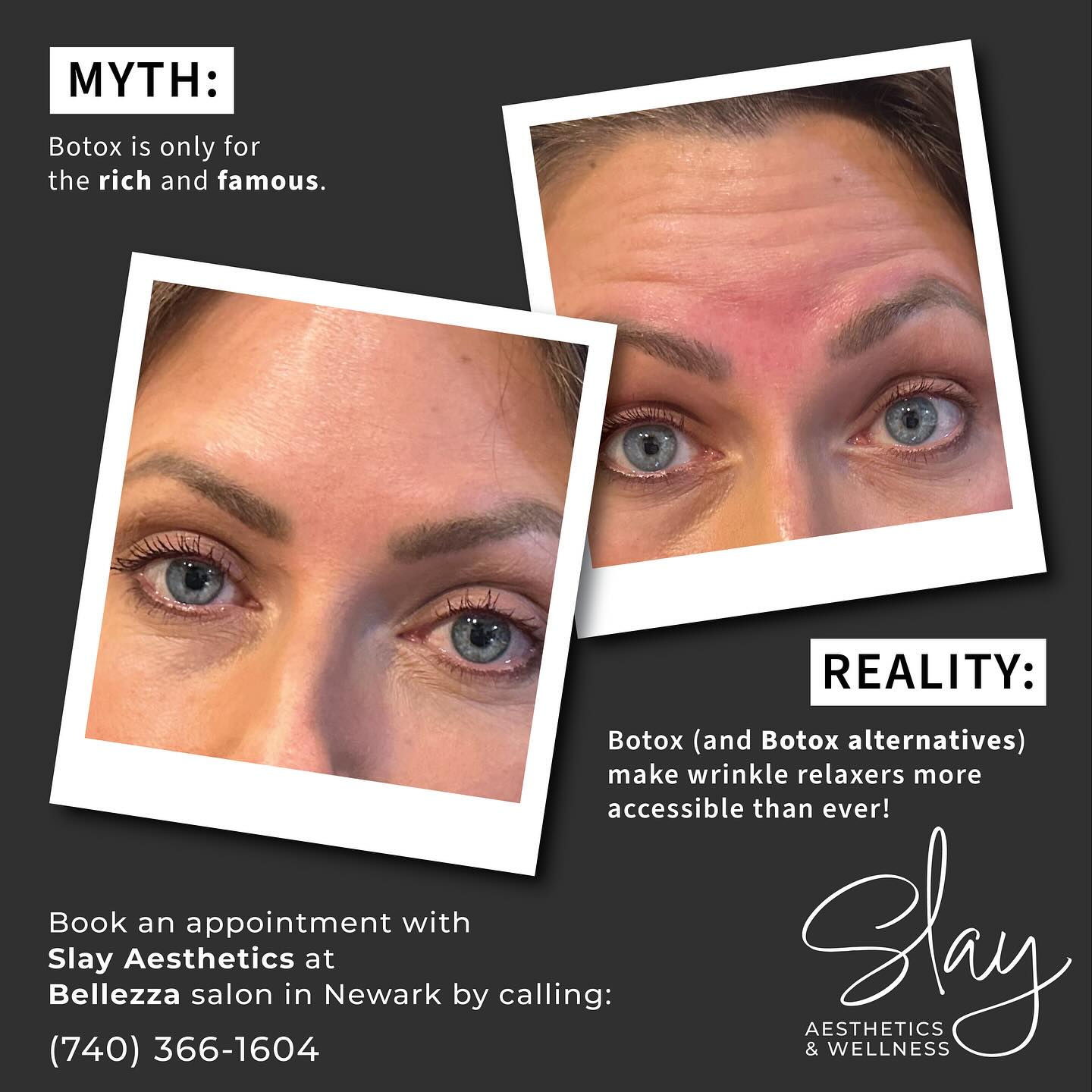 Botox for all!! 🤣 Slay Aesthetics offers affordable wrinkle relaxer prescription medication such as Xeomin at prices you may find surprising, and we’ll only sell you as much as you need to get great results! Call and book a consultation today! #botox #botoxmyth #xeomin #wrinklerelaxers #bellezza #bellezzanewark #defyaging