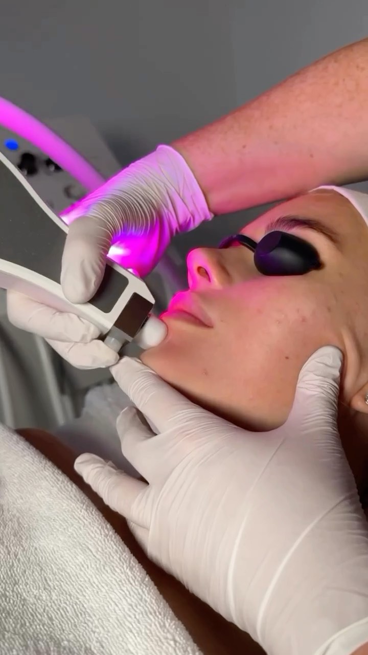 SKINSTORM
Our most advanced facial yet. Let us help you elevate your skin and facials to our newest treatment SkinStorm by @crystalclear.
The results we are seeing from our clients taking a course of 6 is phenomenal. This facial is literally transforming peoples skin and confidence.
This treatment super-cleanses, resurfaces, hydrates, and stimulates collagen production, boosting skin cells and leaving skin feeling plump and glowing. We can target all concerns from, dull dehydrated skin, acne scaring, ageing, lax skin, pigmentation and much more. Overall stimulates and regenerates cells to give immediate optimum results and long-term results. We treat the skin of now and the skin of the future.
If you want to know more about this revolutionary treatment where we combine luxury with results then please get in touch. 01704834003
#crystalclearskincare #crystalclearskin #beautysalon #formby #liverpool #skincare #skincareroutine #facial #antiageing #microdermabrasion #microneedling #beautytips #beautyaddict #relaxation