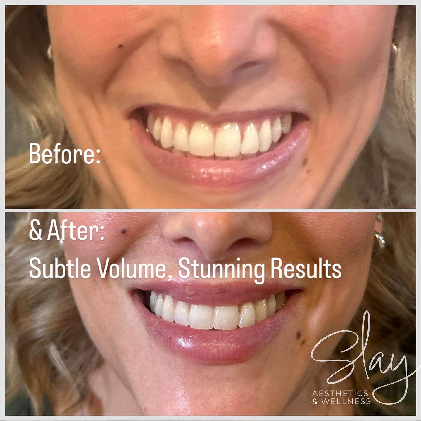Book your appointment now and love your lips even more. Book an appointment at Bellezza Salon or DM us here at Slay Aesthetics for details. #LipFiller #PoutPerfection #BeforeAndAfter #BeautyEnhancement #ConfidenceBoost #revanesse #versa