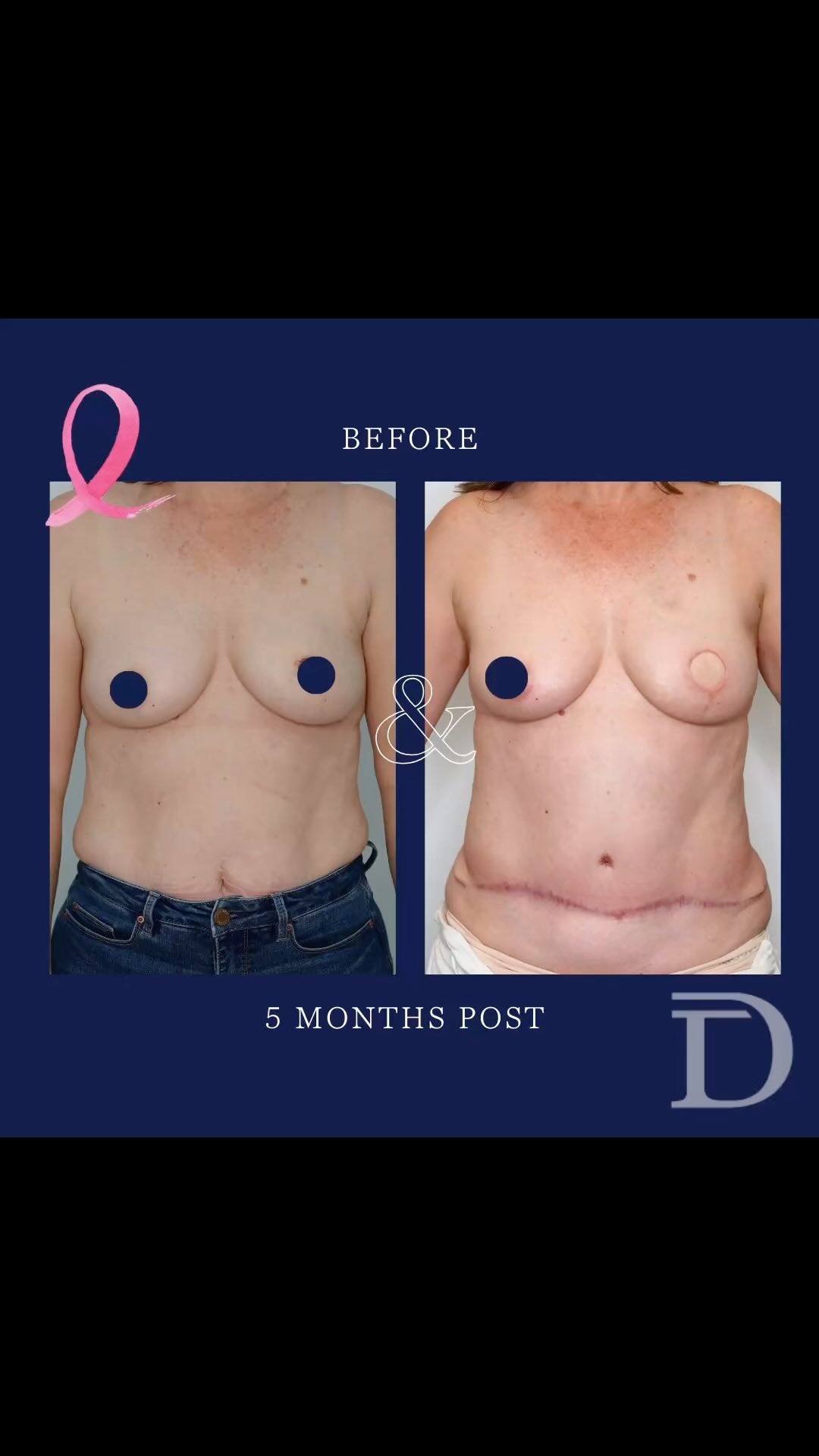 Left Mastectomy + Immediate DIEP Breast Reconstruction 
1. Pre Surgery 
2. 5 Months Post
- Scars take 12 - 18 months to mature/ fade
- Patient is now ready for a nipple reconstruction procedure
Surgery Performed by Dr Duncan Taylor (MED0001883464) Specialist Plastic & Reconstructive Surgeon.
🔹 Outcomes achieved in these photos are only relevant to this patient and do not necessarily reflect the results other patients may experience.
🔹There are inherent risks associated with any surgical or invasive procedures. The recovery period varies based on the specific procedure, and individual outcomes will differ.
🔹More information about risks and recovery for each procedure is available on our website www.drduncantaylor.com.au, on the procedure information sheets.
🔹We recommend getting a second opinion from a qualified health practitioner before proceeding.
🔹 This patient gave photo consent. 
#unilateralbreastreconstruction #unilateralmastectomy #unilateraldiepflap #microsurgicalbreastreconstruction #diepbreastreconstruction #autologousbreastreconstruction #perthbreastreconstruction #breastreconstructionperth #breastcancerperth #perthbreastcancer #mastectomyperth #perthmastectomy #specialistplasticsurgeon #plasticsurgeryperth #perthplasticsurgery