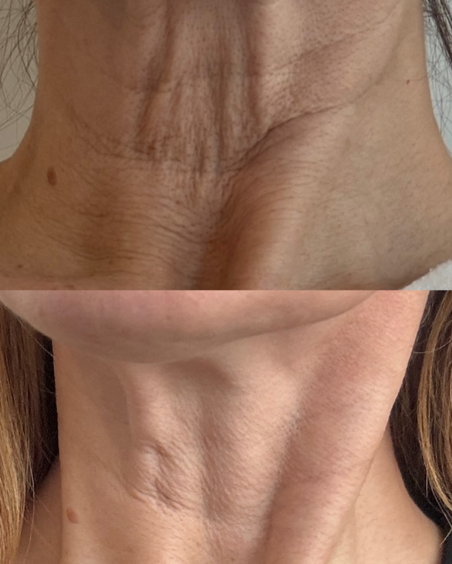✨ The Power of the NEOGEN Neck Lift! ✨
The neck is one of the first areas to show age—yet it’s often overlooked. NEOGEN PSR lifts, tightens, and regenerates by stimulating Type 1 & Type 3 collagen, improving skin at a cellular level without surface damage.
💡 This model’s journey:
✔ Sept 2024: 1 low-energy treatment
✔ 30 days ago: 1 medium-energy treatment
✔ Results will continue improving for 9-12 months!
Treating the neck with the face ensures a balanced, youthful look. Don’t let your neck tell a different story! #StayTuned for the transformation.
Book your free consultation today!
#NeogenNeckLift #CollagenBoost #TimelessBeauty