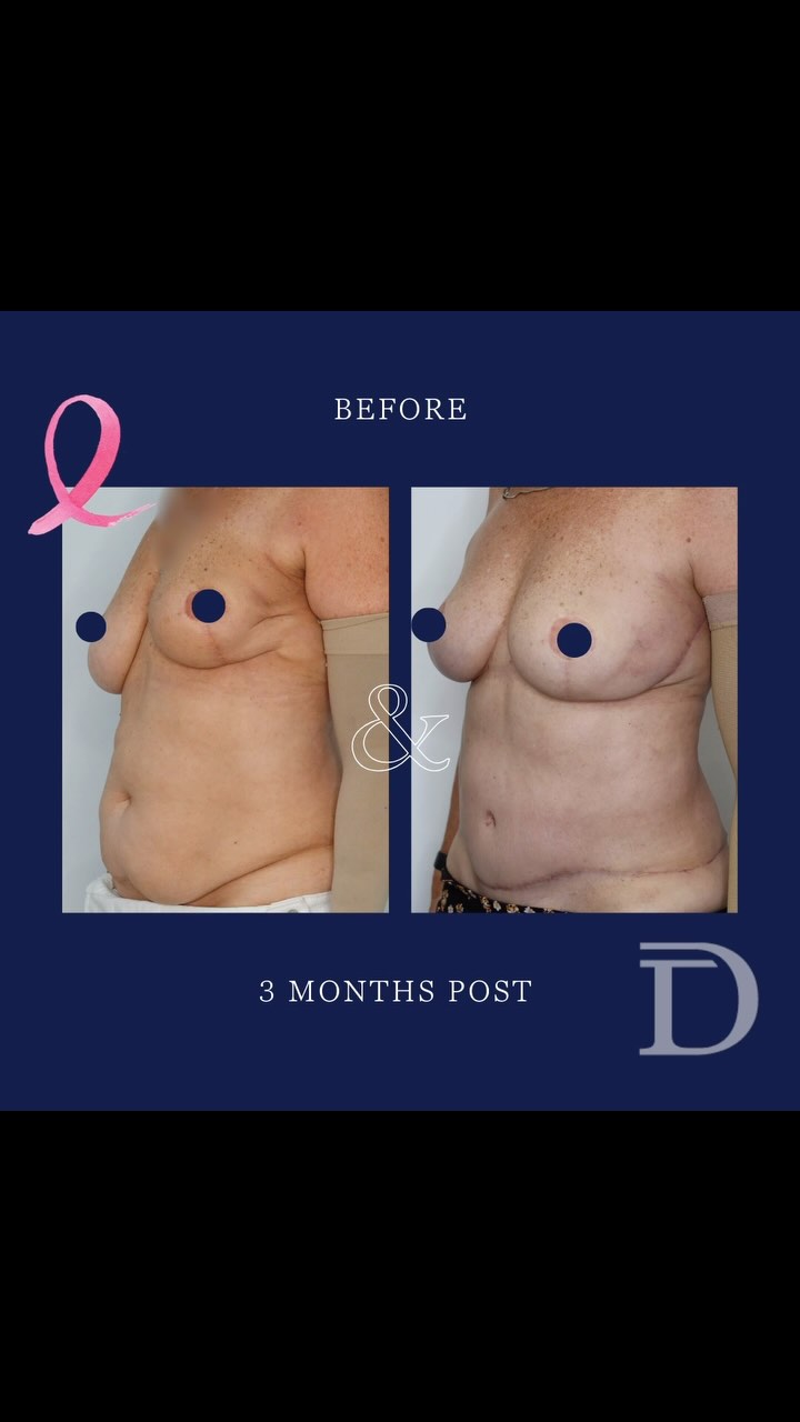 Breast Reconstruction Surgery 
1. Pre Surgery 
2. 5 Months Post Stage 2
- Patient had lumpectomy + axillary clearance + radiation therapy for treatment of breast cancer 
* Surgery 1 - excision of extensive scar tissue + free tissue transfer (fat + skin + lymph nodes) from the abdomen to left lateral breast/ axilla 
* Surgery 2 - right breast lift + revision/ re-shaping of left breast imported tissue + bilateral breast fat grafting 
- The breast is now soft + functionally the patient has increased arm movement/ less pain + aesthetically increased  symmetry/ improved shape 
- Scars take 12-18 months to mature/ fade
Surgery Performed by Dr Duncan Taylor (MED0001883464) Specialist Plastic & Reconstructive Surgeon.
🔹 Outcomes achieved in these photos are only relevant to this patient and do not necessarily reflect the results other patients may experience.
🔹There are inherent risks associated with any surgical or invasive procedures. The recovery period varies based on the specific procedure, and individual outcomes will differ.
🔹More information about risks and recovery for each procedure is available on our website www.drduncantaylor.com.au, on the procedure information sheets.
🔹We recommend getting a second opinion from a qualified health practitioner before proceeding.
🔹 This patient gave photo consent. 
#perthbreastreconstruction #breastreconstructionperth #breastreconstructionawareness #lumpectomy #perthbreastcancer #breastcancerperth #radiationdamage #autologousbreastreconstruction #microsurgicalbreastreconstruction #plasticsurgeonperth #perthplasticsurgeon #specialistplasticsurgeon #perthplasticsurgery #plasticsurgeryperth