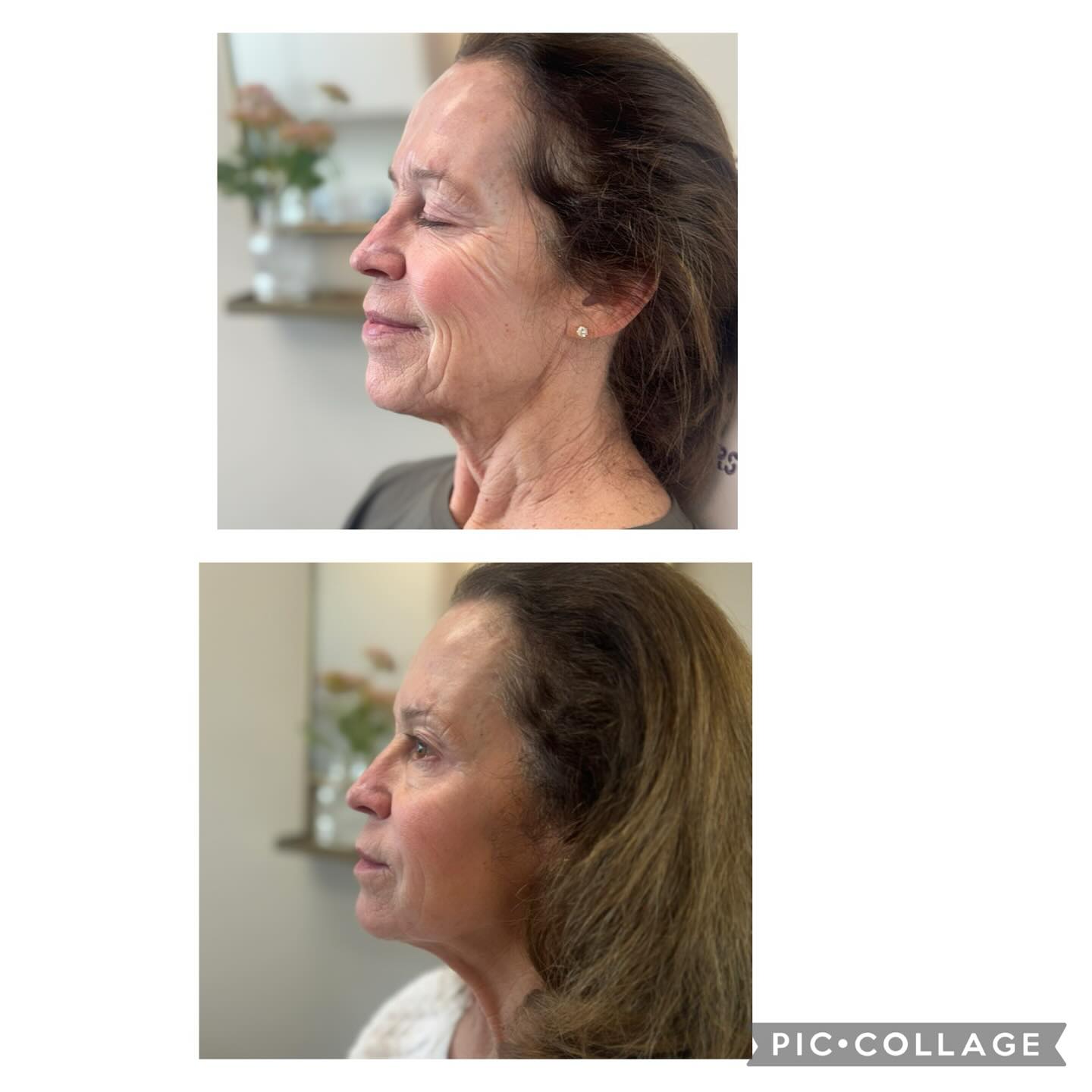 🩷 Alllllllll the feels with this beauties results 🤩. Here’s what we did:::
.
🥰 Lower Face Filler adds volume, smooths wrinkles, and enhances contours (chin, jawline, etc.) using dermal fillers.
.
🥰 Neck/Jaw Botox works by relaxing muscles to reduce neck bands, smooth wrinkles, and soften the jawline
.
Both treatments offer non-surgical ways to improve facial aesthetics with minimal downtime and noticeable results
.
#cloudnineclinic #juvederm #restylane #reclaiming #botoxcosmetic #botoxhighlandsranch #dysport
.
Cloud Nine Clinic: Medical Spa
9330 S University Blvd. suite 220
Highlands Ranch Co 80129
720 360 5383 (call or text)