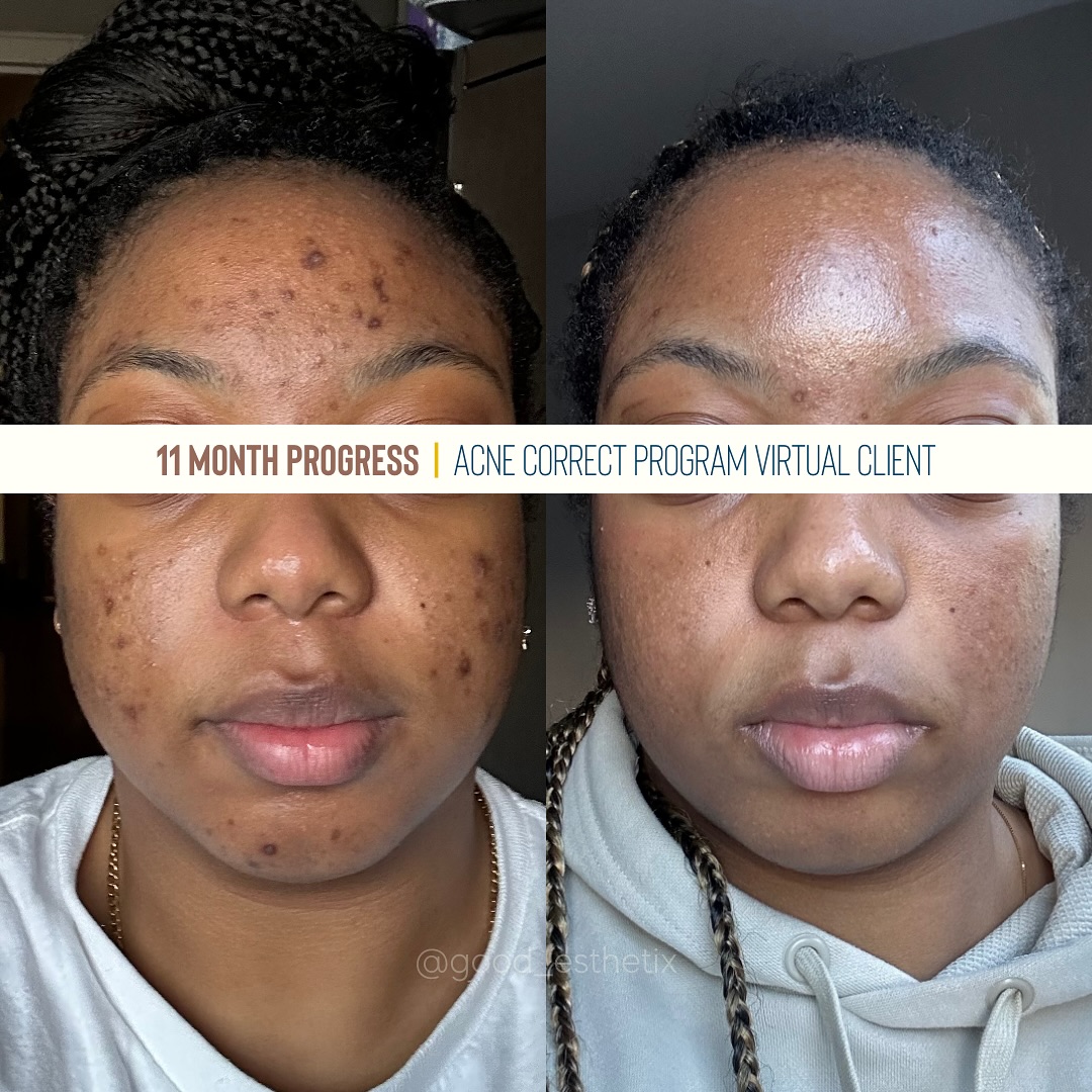 Progress > Perfection
So proud to share my virtual client’s progress over the last 11 months! 😍
We achieved these results through a fully customized home care routine from @facerealityskincare and practical changes to a few lifestyle habits.
She was patient, consistent and trusted the process and her skin is reaping the benefits. ✨
We’ll target scarring, even tone and resurfacing with in-person treatments once she’s home from school!
#nycesthetician #brooklynesthetician #acnespecialist #acneexpert #correctiveskincare #hyperpigmentation #acnetreatment #nycskincare