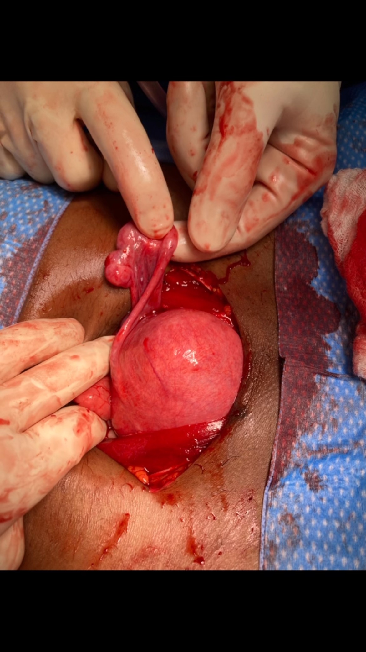 ✨ My Fibroid Journey: From Pain to Purpose ✨
There was a time when my days were filled with excruciating sciatic nerve pain, and my nights were restless with discomfort. My fibroids had grown so large that they blocked my bowel and bladder, leading me down a path I never expected—my first myomectomy surgery. 💔
What I didn’t realize then was that this painful chapter would become the catalyst for my purpose. I turned my journey of healing into a mission: helping other high-achieving women take back control of their womb health, holistically and naturally. 🌱
If you’ve ever felt lost, overwhelmed, or betrayed by your own body, know this—you are not alone. 💛
I’ll be sharing more of my story this week, along with practical tips and insights that helped me find relief and healing. Drop a ❤️ if you’ve been through something similar or tag a friend who needs to hear this!
#FibroidWarrior #WombWellness #HolisticHealing #MindBodySoul #WomenSupportingWomen