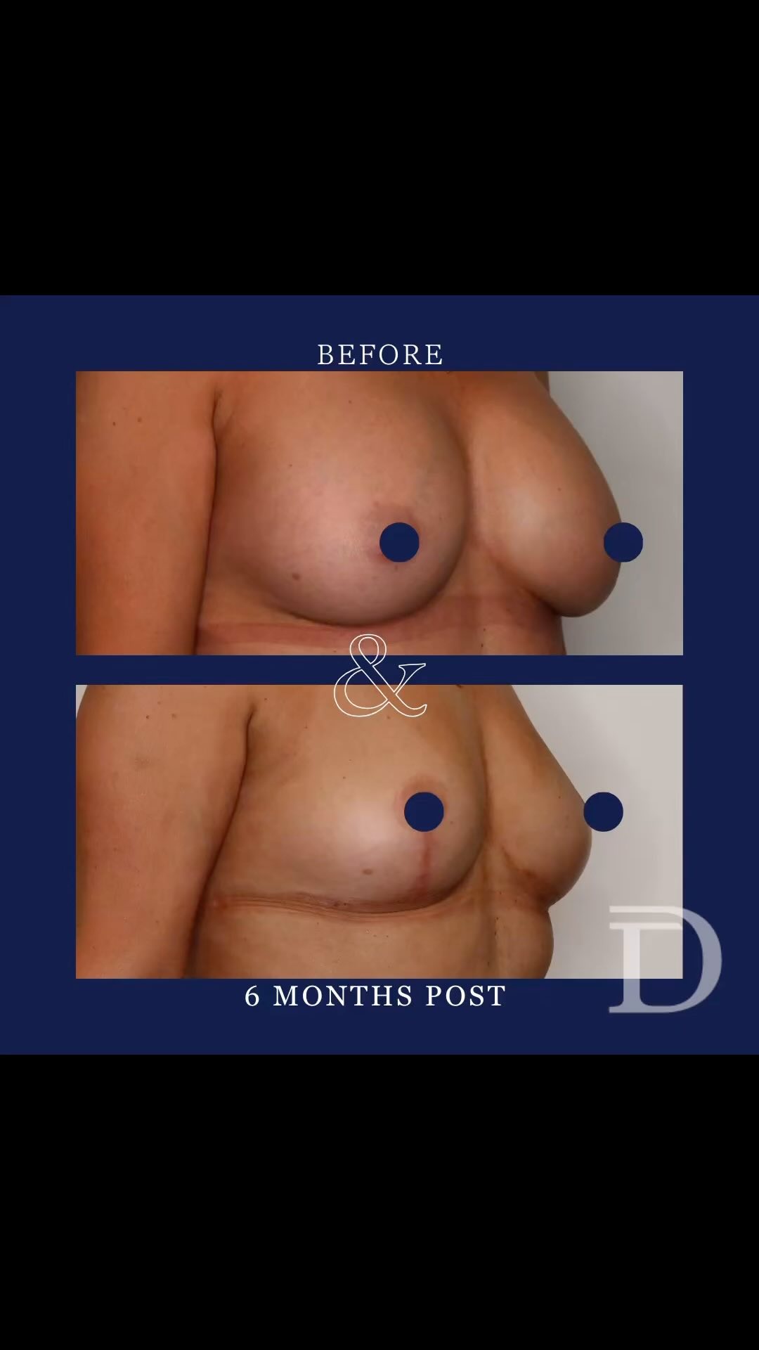 Removal of Breast Implants + Mastopexy (Breast Lift) + Fat Grafting 
1. Pre Surgery 
2. 6 Months Post Op
* Scars take 12-18 months to mature/ fade
Surgery Performed by Dr Duncan Taylor (MED0001883464) Specialist Plastic & Reconstructive Surgeon.
🔹 Outcomes achieved in these photos are only relevant to this patient and do not necessarily reflect the results other patients may experience.
🔹There are inherent risks associated with any surgical or invasive procedures. The recovery period varies based on the specific procedure, and individual outcomes will differ.
🔹More information about risks and recovery for each procedure is available on our website www.drduncantaylor.com.au, on the procedure information sheets.
🔹We recommend getting a second opinion from a qualified health practitioner before proceeding.
🔹 This patient gave photo consent. 
#explantsurgery #explantperth #breastimplantremoval #breastlift #mastopexy #fatgrafting #breastliftperth #plasticsurgeryperth #perthplasticsurgery #perthplasticsurgeon #plasticsurgeonperth #breastimplantremovalperth #specialistplasticsurgeon