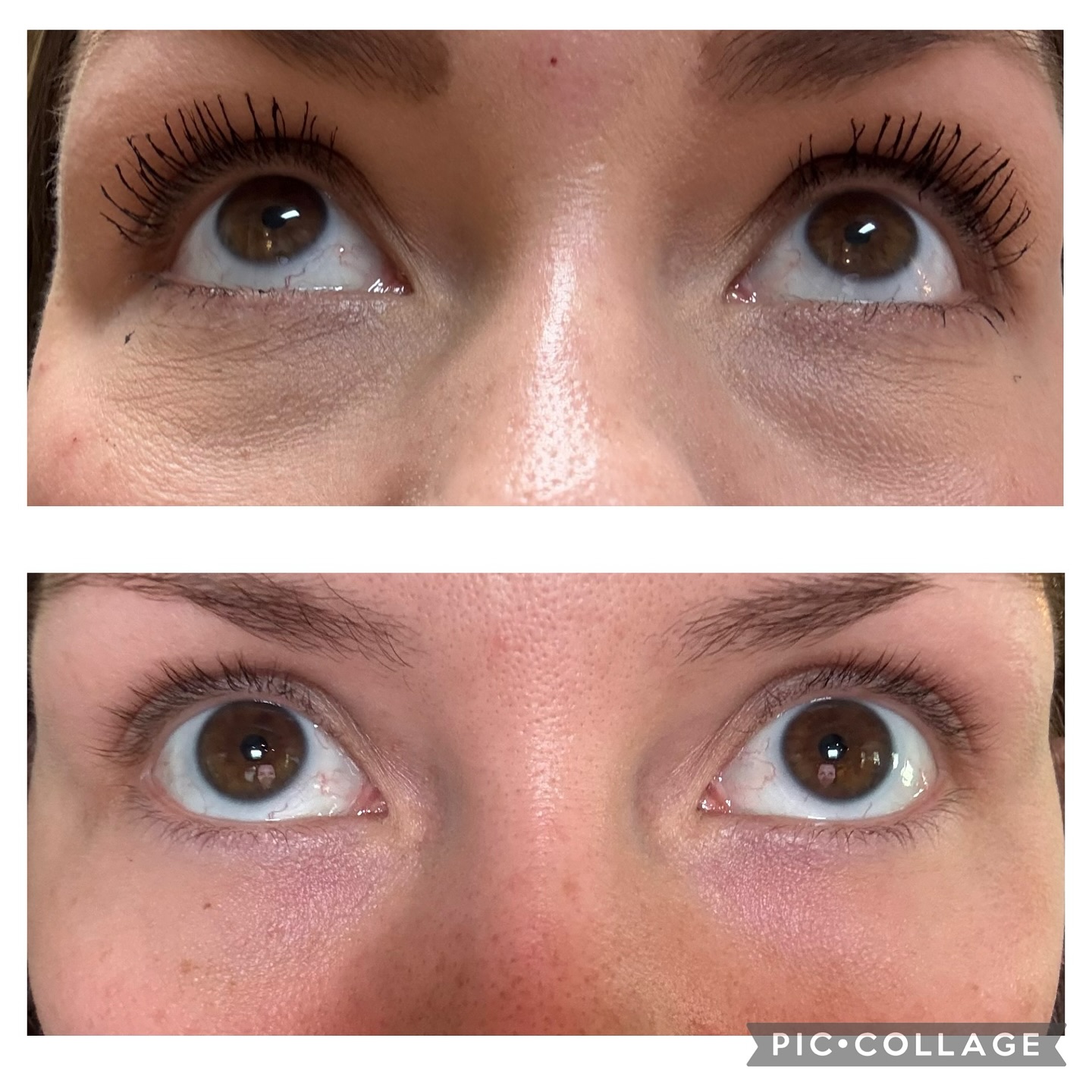 😍 Amazing Transformation Alert!😍
Check out these before-and-after results from just one Light Eyes treatment using polynucleotides under the eyes! Before and after photo is results after just ONE week!!!!!
Wrinkles? Softened.
Dark circles? Brightened.
Confidence? Boosted.
This incredible non-surgical refresh is just $300 per session.
Book your appointment with Dr. Dupon today and bring life back to your eyes!
#DrDuponAesthetics #LightEyesTreatment #UnderEyeRefresh #Polynucleotides #AntiAging #BeforeAndAfter #GlowingSkin