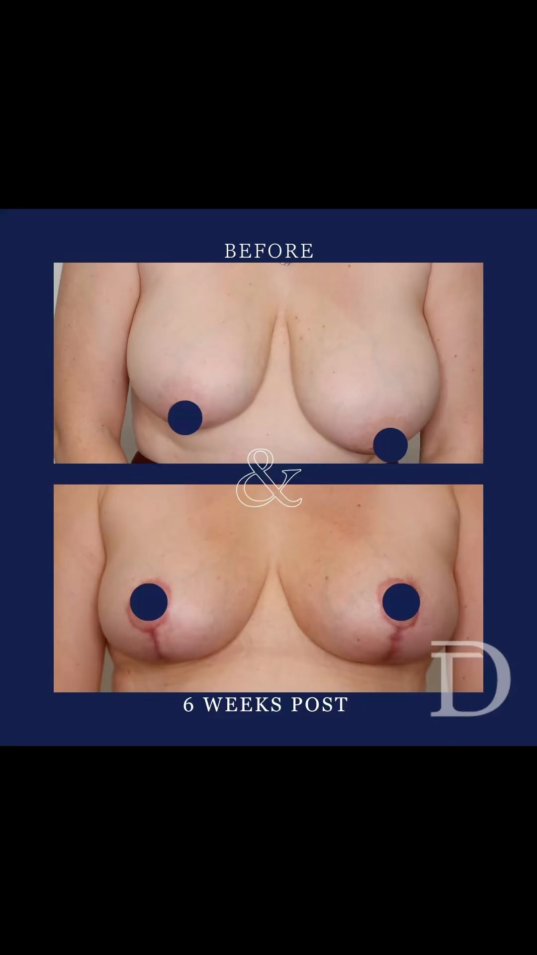 Bilateral Breast Reduction 
1. Pre Surgery 
2. 6 Weeks Post Op
- Scars take 12-18 months to mature/ fade
- Patient to wear post operative compression bra for the first 6 weeks and no underwire bras for the first 3-4 months post surgery 
Surgery Performed by Dr Duncan Taylor (MED0001883464) Specialist Plastic & Reconstructive Surgeon.
🔹 Outcomes achieved in these photos are only relevant to this patient and do not necessarily reflect the results other patients may experience.
🔹There are inherent risks associated with any surgical or invasive procedures. The recovery period varies based on the specific procedure, and individual outcomes will differ.
🔹More information about risks and recovery for each procedure is available on our website www.drduncantaylor.com.au, on the procedure information sheets.
🔹We recommend getting a second opinion from a qualified health practitioner before proceeding.
🔹 This patient gave photo consent. 
#breastreduction #breastreductionsurgery #breastreductionperth #perthbreastreduction #breastsurgeryperth #perthbreastsurgery #plasticsurgeryperth #perthplasticsurgery #plasticsurgeonperth #perthplasticsurgeon #specialistplasticsurgeon