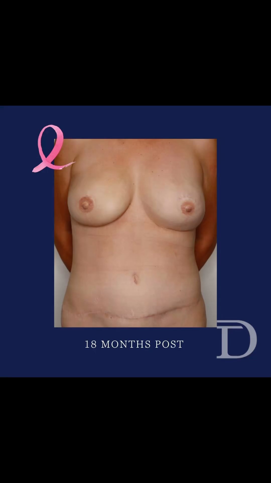 Bilateral Mastectomy + Bilateral DIEP Breast Reconstruction + Nipple Reconstruction + Areolar Tattooing performed by @whitneyhaze_aesthetics 
1. Pre Surgery 
2. 18 Months Post Op
- Scars take 12-18 months to mature/ fade
- Autologous breast reconstruction softens/ settles over time, scars fade/ mature,  the tissue feels warm to touch and soft/ comfortable on the chest wall. 
Surgery Performed by Dr Duncan Taylor (MED0001883464) Specialist Plastic & Reconstructive Surgeon.
🔹 Outcomes achieved in these photos are only relevant to this patient and do not necessarily reflect the results other patients may experience.
🔹There are inherent risks associated with any surgical or invasive procedures. The recovery period varies based on the specific procedure, and individual outcomes will differ.
🔹More information about risks and recovery for each procedure is available on our website www.drduncantaylor.com.au, on the procedure information sheets.
🔹We recommend getting a second opinion from a qualified health practitioner before proceeding.
🔹 This patient gave photo consent. #autolgousbreastreconstruction #diepreconstruction #nipplereconstructionsurgery #perthbreastreconstruction #breastreconstructionperth #breastcancerperth #perthbreastcancer #breastcancerreconstruction #breastcancerreconstructionsurgery #perthplasticsurgeon #plasticsurgeonperth #specialistplasticsurgeon