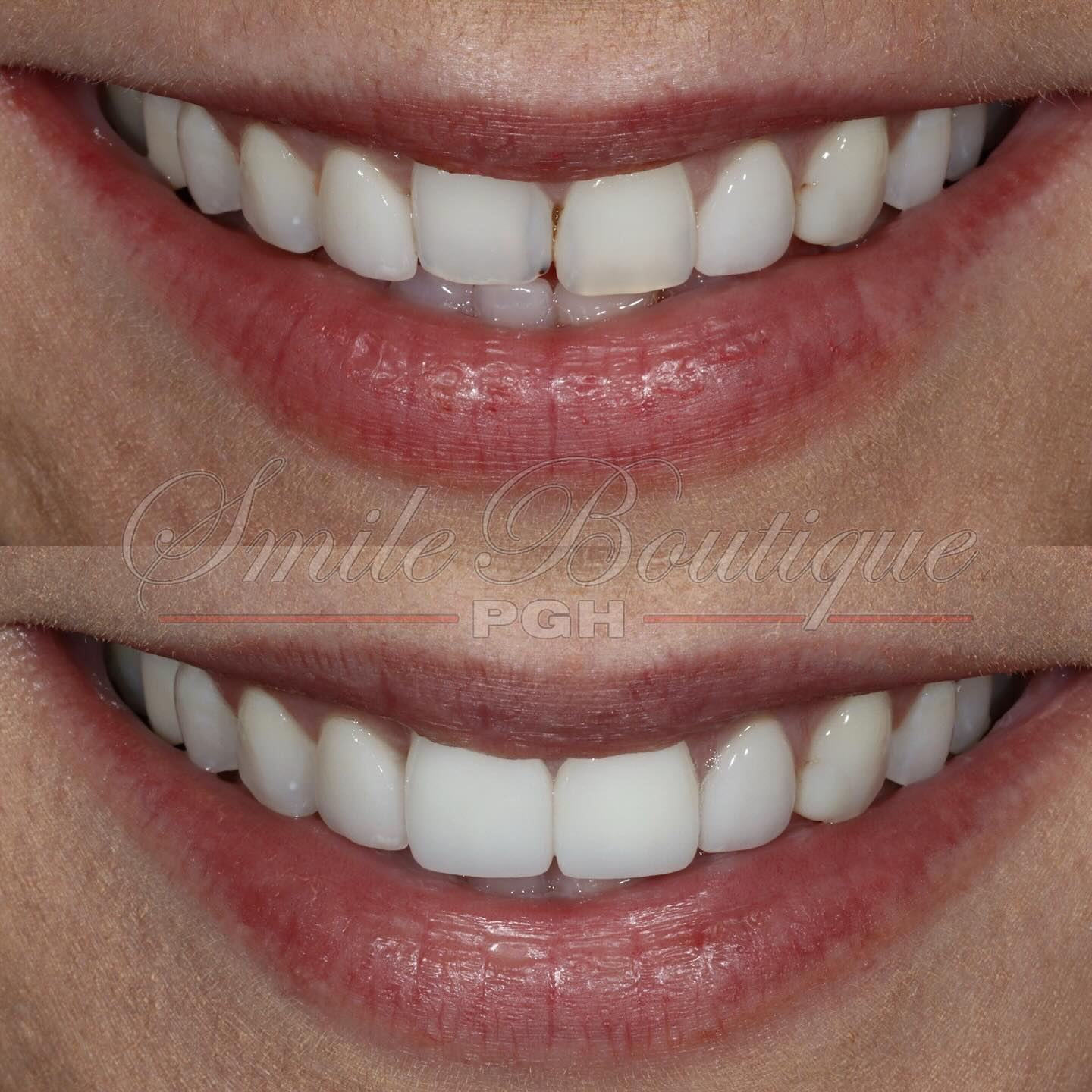 Throwback Thursday 🔙
Featuring on how a small smile makeover involving just two front teeth can have such a powerful impact! I had the wonderful privilege to work with @mandylynn892 who reach out to me back in 2020 complaining about how she hated to smile and afraid to eat because of her old bondings between her two front teeth were causing her paranoia. Bondings were initially used to attempt to close the natural gap that she had between her two front teeth and deteriorated over time.
“Bondings” are often called and also known as:
- Composite restorations
- White fillings
- Resin
Bondings are good material of choice for cosmetic purposes because they cost much less than ceramics (hundreds vs thousands) and they can be placed on faster than ceramics. A cheaper & fast option. Their disadvantages on front teeth are:
🔻 Staining over time
🔻 Weaker material then ceramics (breaks often)
🔻 Traps food
🔻 Deteriorates with a “melted look”
To address Amanda’s concerns and smile goals, NO MORE Bondings! Two (2) lithium disilicate (LD)Veneers were prescribed = A happy patient who can now smile and eat confidently 🤩 As a side bonus (literally), Amanda can now also chew better on one side because we replaced her missing tooth in the back!
To see what a smile transformation by Dr. Shieh can do for you, book a consult meeting to learn more (link in bio).
Do you Bondings in your front teeth that you don’t like?
#tbt #throwback #thursdayvibes #smilemore #smiletransformation #smilemakeover #smiles #smiledesign #cosmetic #cosmeticdentistry #cosmeticdentist #pittsburgh #pittsburghdentist #topdentist #wowsmile #happypatients #newyearnewme #newyearnewyou #treatyourself #treatyoself #luxurylifestyle #sexysmile #beyou #beconfident #whosnext #alwayssmile #loveit #veneers #dentalveneers #cosmeticveneers