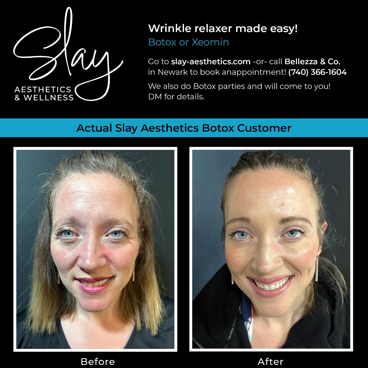 Smooth results you can see!
Check out this before & after of our wrinkle-relaxing magic using Botox & Xeomin!
Subtle, natural, and refreshed — just the way it should be.
Book your appointment today and put your best face forward! Visit our website or DM directly.
#WrinkleRelaxer #Botox #Xeomin #BeforeAndAfter #SmoothSkin #RefreshYourLook #springfresh