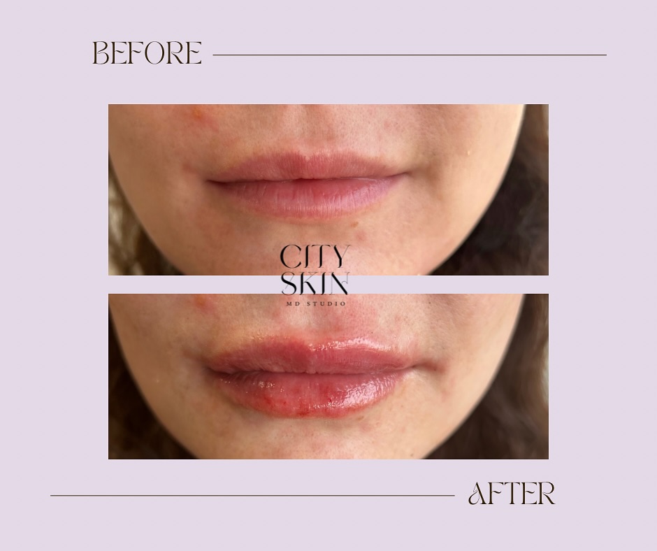 Don’t forget about our special offer of ½ syringe of dermal filler for just $400!! ✨
Plus as a special bonus, you’ll also receive our signature facial to leave your skin GLOWING.
Book yours today👇
cityskinmds.com for availability 👄
✔️ Limited time only!!
#skincaregoals #cityskinmds #glowingskin #cityskinmd #radiantskin #lipfillers #wearecityskin #supportsmallbusiness #facials #signaturefacial