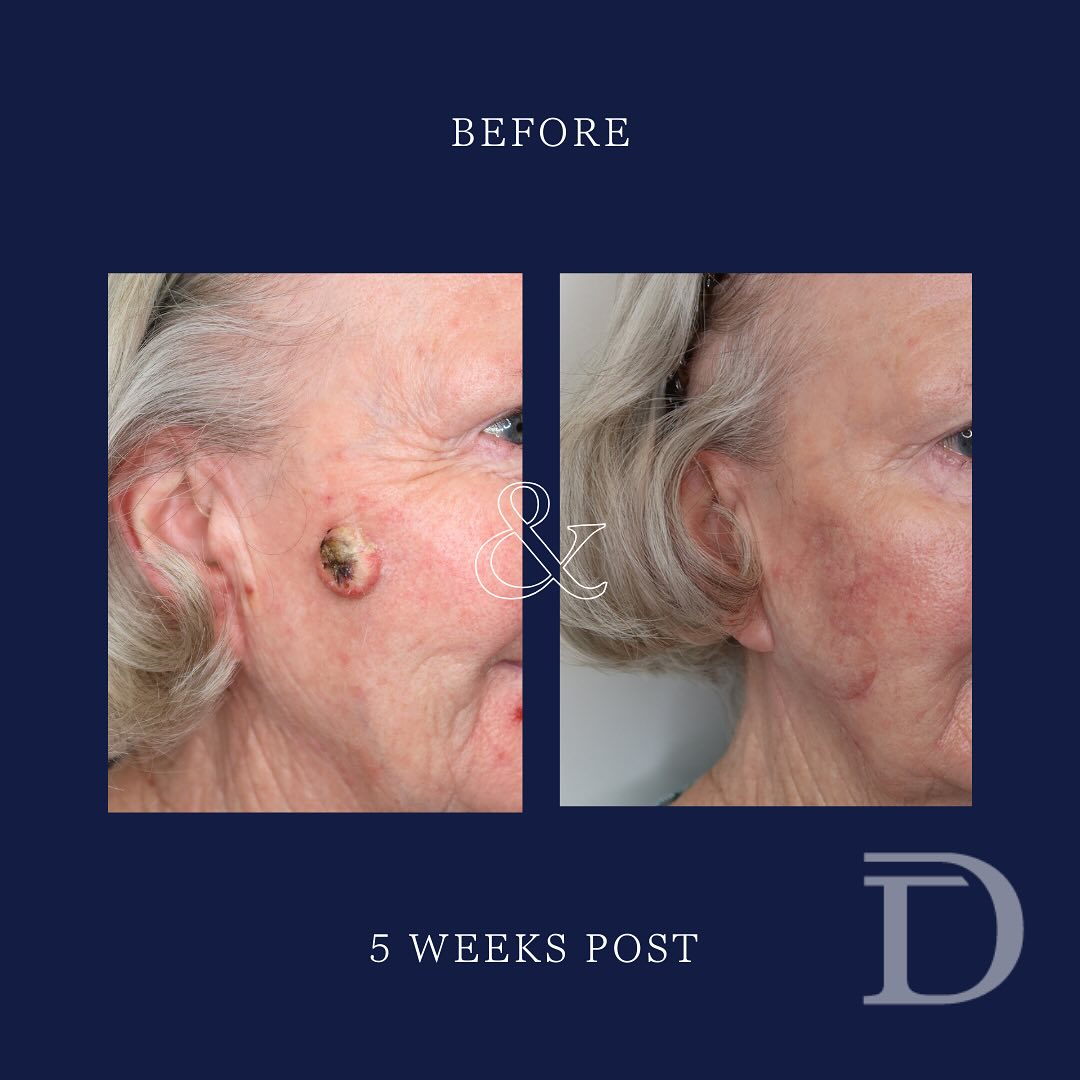 Excision of Squamous Cell Carcinoma skin cancer + local flap reconstruction. 
1. Pre Surgery 
2. 5 Weeks Post Op
3+4. Intra-Op
- Scars take 12-18 months to mature/ fade
Surgery Performed by Dr Duncan Taylor (MED0001883464) Specialist Plastic & Reconstructive Surgeon.
🔹 Outcomes achieved in these photos are only relevant to this patient and do not necessarily reflect the results other patients may experience.
🔹There are inherent risks associated with any surgical or invasive procedures. The recovery period varies based on the specific procedure, and individual outcomes will differ.
🔹More information about risks and recovery for each procedure is available on our website www.drduncantaylor.com.au, on the procedure information sheets.
🔹We recommend getting a second opinion from a qualified health practitioner before proceeding.
🔹 This patient gave photo consent. 
#squamouscellcarcinoma #skincancerperth #perthskincancer #localflapreconstruction #skincancerreconstruction #perthplasticsurgeon #plasticsurgeonperth #specialistplasticsurgeon #skincancersurgery #skincancerawareness