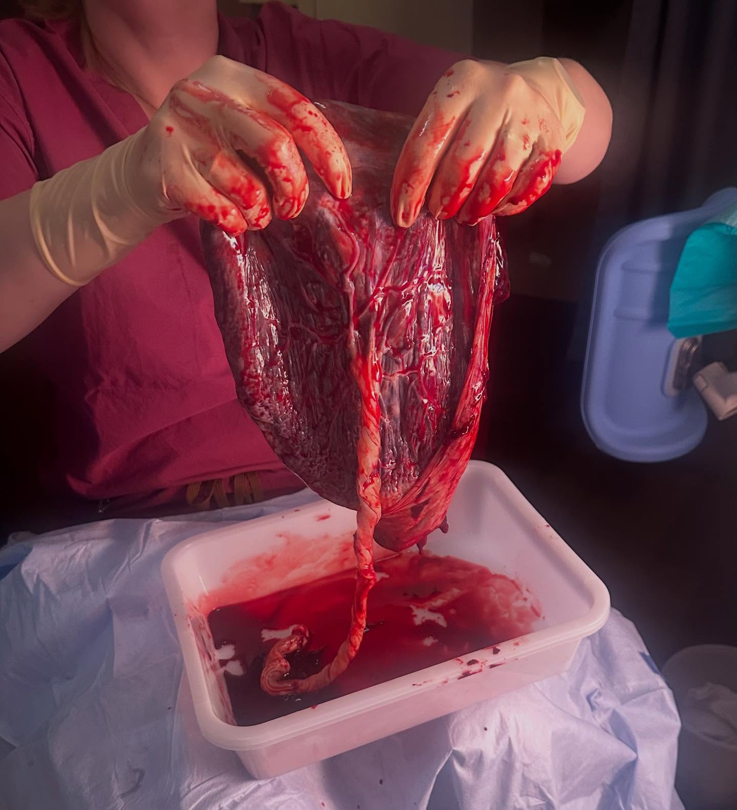 The placenta is the lifeline that connects, nourishes, and protects!
A healthy placenta is key to a healthy pregnancy. This incredible organ nourishes and supports your baby throughout the entire journey. Here’s how you can help keep it thriving:
🥗Eat a nutrient-rich diet- Focus on foods rich in vitamins and minerals, especially folate, iron, and calcium.
💧Stay hydrated - Drinking plenty of water is essential for maintaining optimal blood flow to the placenta.
🏃🏻♀️Move your body - Regular, gentle exercise boosts circulation and supports placenta health.
🧘🏻♀️Manage stress - High stress can affect the placenta, so take time to relax and unwind.
💊Prenatal vitamins - Ensure you’re taking the right supplements, as advised by your healthcare provider. Some nutrients critical to the placenta include folate, vitamin D, vitamin B12, vitamin A, and iron.
Take care of your placenta, and it’ll take care of you and your baby!
#HealthyPregnancy #PlacentaCare #PregnancyJourney #NourishYourBody #placenta #fairfaxdoula #loudoundoula
