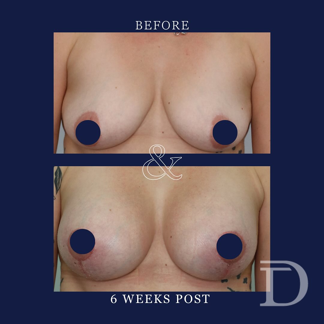 Bilateral Breast Augmentation Mastopexy 
1. Pre Surgery 
2. 6 Weeks Post Op
- Scars take 12-18 months to mature/ fade
- 335cc full projection + smooth round implants 
Surgery Performed by Dr Duncan Taylor (MED0001883464) Specialist Plastic & Reconstructive Surgeon.
🔹 Outcomes achieved in these photos are only relevant to this patient and do not necessarily reflect the results other patients may experience.
🔹There are inherent risks associated with any surgical or invasive procedures. The recovery period varies based on the specific procedure, and individual outcomes will differ.
🔹More information about risks and recovery for each procedure is available on our website www.drduncantaylor.com.au, on the procedure information sheets.
🔹We recommend getting a second opinion from a qualified health practitioner before proceeding.
🔹 This patient gave photo consent. 
#augmentationmastopexy #augmentmastopexy #breastaugmentationperth #perthbreastaugmentation #breastliftperth #perthbreastlift #perthplasticsurgeon #plasticsurgeonperth #cosmeticsurgeryperth #perthcosmeticsurgery #specialistplasticsurgeon #motivaimplants #motivabreastimplants