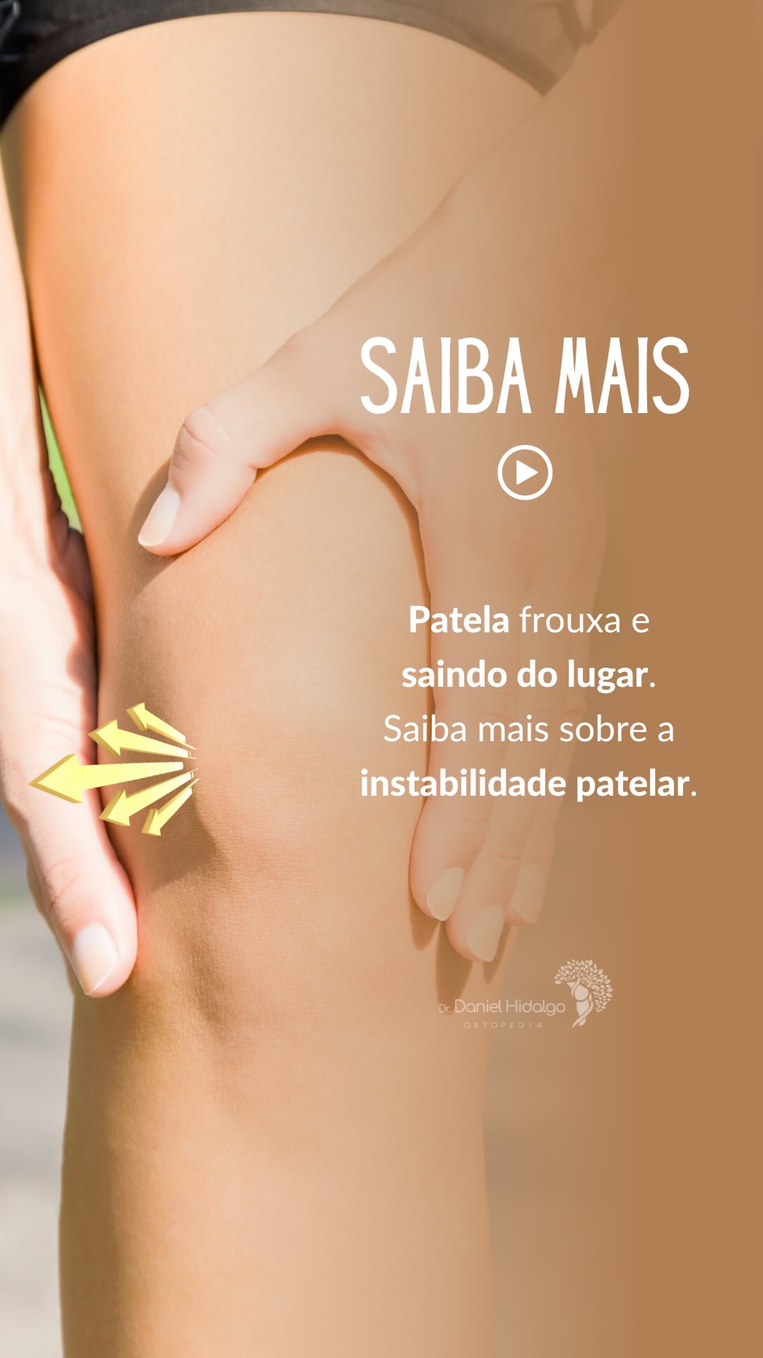 ✨O deslocamento da patela para a região externa do joelho pode ser causado por uma instabilidade da articulação entre a patela e o fêmur. #joelho #patela #instabilidadepatelar