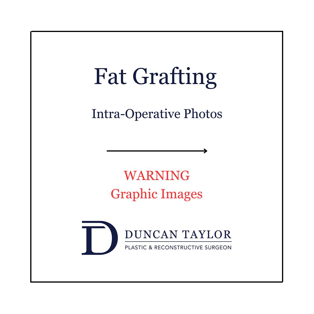 Breast Lift + Fat Grafting 
1. Left Breast Pre Fat Grafting & Right Breast Post Fat Grafting 
2. Bilateral Breasts Post Fat Grafting 
- Fat is harvested using liposuction (common donor sites thighs and abdomen), the fat is then processed and injected into the breasts 
Surgery Performed by Dr Duncan Taylor (MED0001883464) Specialist Plastic & Reconstructive Surgeon.
🔹 Outcomes achieved in these photos are only relevant to this patient and do not necessarily reflect the results other patients may experience.
🔹There are inherent risks associated with any surgical or invasive procedures. The recovery period varies based on the specific procedure, and individual outcomes will differ.
🔹More information about risks and recovery for each procedure is available on our website www.drduncantaylor.com.au, on the procedure information sheets.
🔹We recommend getting a second opinion from a qualified health practitioner before proceeding.
🔹 This patient gave photo consent. 
#fatgraftingsurgery #fatgraftingperth #breastaugmentationperth #perthbreastaugmentation #breastliftperth #perthbreastlift #perthplasticsurgeon #plasticsurgeonperth #plasticsurgeryperth #perthplasticsurgery #perthfatgrafting #specialistplasticsurgeon