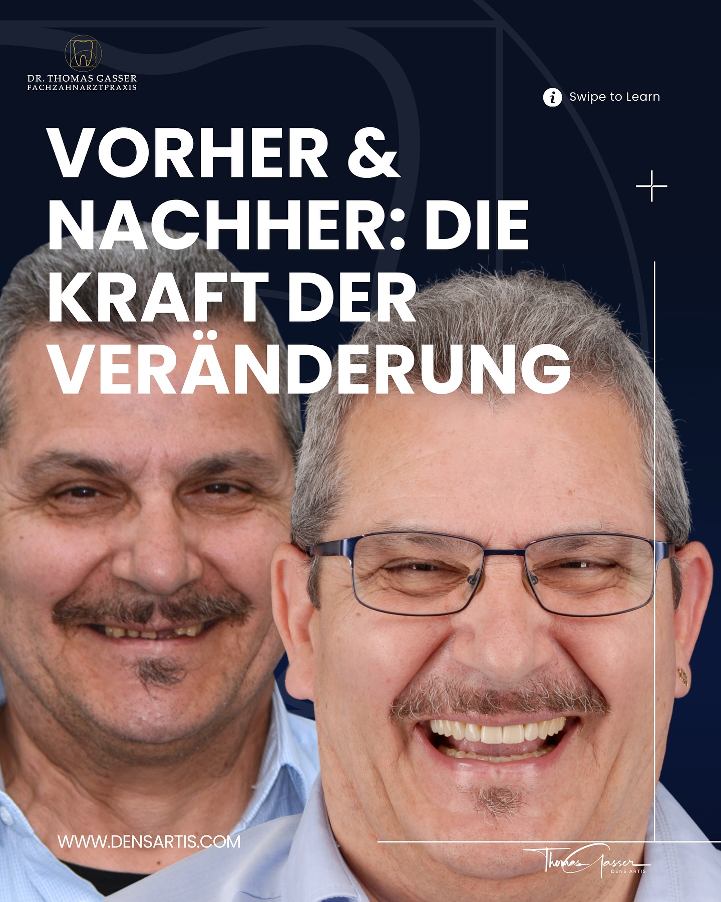 ✨ Ein neues Lächeln
Still und schleichend – so verlaufen Veränderungen, die wir im Alltag kaum bemerken.
Bei diesem Patienten führte jahrelanges Knirschen und langsame Abnutzung dazu, dass die Zähne immer kürzer wurden. Die Kaufunktion litt, das Gesicht verlor an Ausdruck.
Gemeinsam gingen wir den Weg einer umfassenden Full Mouth Rehabilitation – Schritt für Schritt, mit viel Planung, Geduld und Präzision.
🔍 Die Behandlung im Überblick:
• Implantate wurden gesetzt, dort wo Zähne fehlten – mit einem komplexen Knochenaufbau im Bereich der Nasennebenhöhlen (Sinuslift).
• Das Zahnfleisch wurde durch ein Weichgewebstransplantat modelliert – für eine natürliche, harmonische Zahnfleischlinie und stabile Verhältnisse rund um die Kronen.
• Die eigenen Zähne wurden sanft präpariert – nicht mehr als nötig.
Die Zähne wirken frischer, das Lächeln lebendiger – ohne künstlich zu wirken.
📍 Fachzahnarztpraxis Dr. Thomas Gasser
Greifengasse 1, 4058 Basel
📞 Telefon: +41 61 681 00 10
📧 E-Mail: fachzahnarztpraxis_basel@sso-hin.ch
🌐 Website: www.densartis.ch
📍**#ZahnarztBasel #GesundesLächeln #BaslerZahnarzt #Basel #BaselSwitzerland #Schweiz #Baselstadt #BaselLiebe #Zahnmedizin #Zahnarztpraxis #Zahngesundheit #Implantologie #Zahnersatz #Prophylaxe #ÄsthetischeZahnmedizin #MittlereBrücke #Straumann #DrThomasGasser #ZahnarztImplantate #Lächeln #GesundeZähne #ZahnmedizinMitHerz #ZahnarztpraxisBasel #Zahngesundheit**