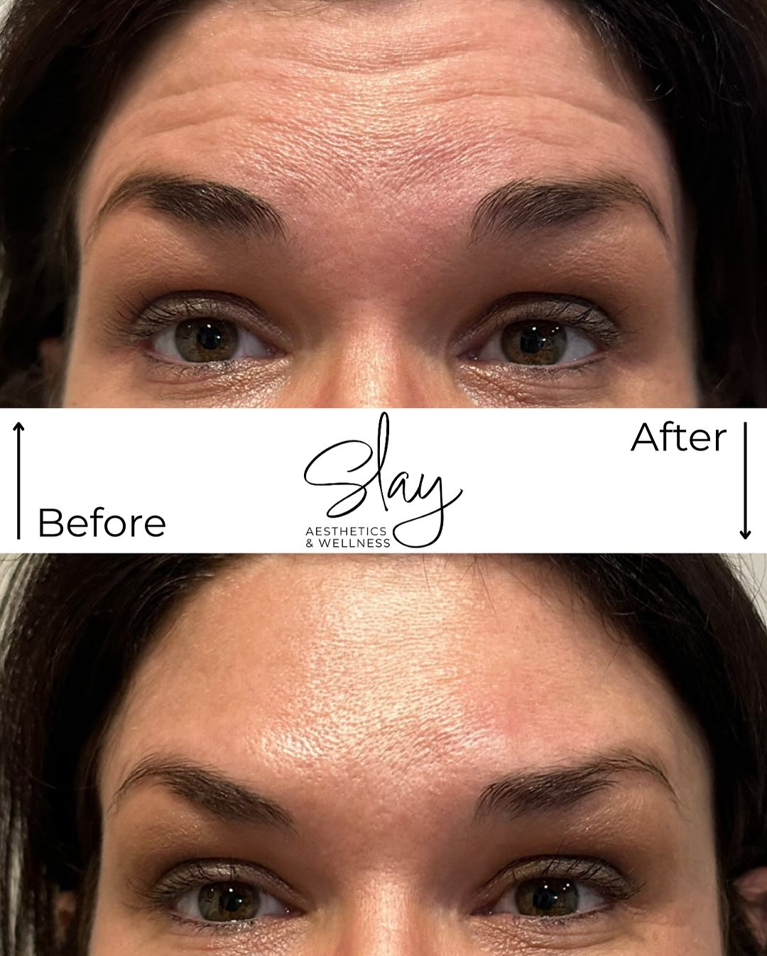 Smooth skin, stunning results! Check out these amazing before and afters of an actual Slay Aesthetics’ patient receiving wrinkle relaxer treatment (Xeomin, Botox).
Appointments available tomorrow at Bellezza & Co in Newark! Call (740) 366-1604 to reserve your spot and start your glow-up.
#WrinkleRelaxer #Botox #Xeomin #BellezzaAndCo #NewarkOhio #BeforeAndAfter #SmoothSkin