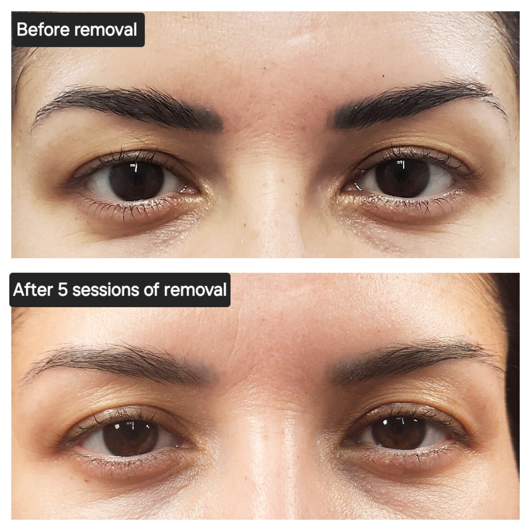 From BOTCHED brows to WOW! ๐โ
5 sessions of @liftinkremoval was done in order to color and shape correct these eyebrows. Thank you @iftinkremoval for giving me the best product out there in order to help my clients achieve the eyebrows they have always wanted. ๐โ
๐ฅLi-FTยฎ is a unique saline removal formula like no other in the world made by Li Pigments. No chemicals, no acids. All natural salt and fruit๐๐ seed extract. Made in a state of the art licensed and inspected manufacturing lab๐ฉโ๐ฌ Li-FTยฎ went through extensive testing by an independent lab for safety. Most importantly...it kicks ass and lightens bad PMU, microblading and body tattoo
#Salinetattooremoval #colorboost #colorcorrection #tattoo #tattooremoval #microbladingcorrection #correct #transformation #removal #pmucorrection #pmu #permanentmakeup #pmuonline #lIftsaline #removemicroblading #salineremoval #pigmentlightening #removalpmu #tattooremoval #liftremoval #liftpigmentremoval #tattoo #microbladingcorrection #correct #badbrows #badtattoo #removal #botched #botchedbrows #eyebrowtattooing
