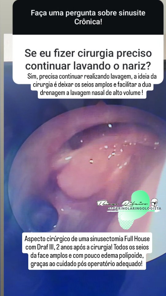 Pós operatório de 2 anos com melhora completa dos sintomas e aspecto cirúrgico de ótimo aspecto!
👉Realizado sinusectomia full House + Draf III para Sinusite Crônica com pólipos nasal ( RSC Eosinofilica)
👉👉👉 Como está sua respiração aí?
👇👇Conte para nós!!! Tem alguma dúvida?
" NOSSO COMPROMISSO É MELHORAR SUA QUALIDADE DE VIDA"
📌Dr. Thiago Ribeiro de Almeida
CRM-SP 180.753/ RQE 88820
Rua Arandu,205 - Conj. 909, Brooklin, São Paulo/SP
Especialista em doenças do nariz
🎈Coordenador do setor de Rinologia da Unisa
🎈 Rinologista pela Unifesp
🎈Título de especialista pela sociedade brasileira de Otorrinolaringologia
🎈 Médico pela UFJF