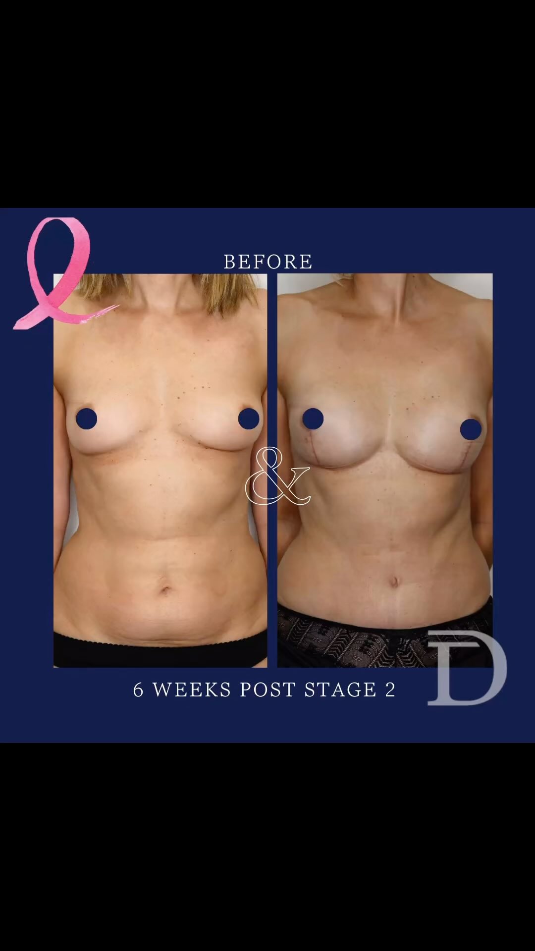 Bilateral Nipple Sparing Mastectomy + Immediate DIEP Breast Reconstruction 
1. Pre Op 
2. 6 Weeks Post Revision Surgery 
* Surgery 1 - Bilateral nipple sparing mastectomy + immediate DIEP reconstruction
* Surgery 2 - Bilateral DIEP removal of skin monitoring paddles (required when nipple sparing mastectomy performed) + fat grafting 
- Scars take 12-18 months to mature/ fade 
Surgery Performed by Dr Duncan Taylor (MED0001883464) Specialist Plastic & Reconstructive Surgeon.
🔹 Outcomes achieved in these photos are only relevant to this patient and do not necessarily reflect the results other patients may experience.
🔹There are inherent risks associated with any surgical or invasive procedures. The recovery period varies based on the specific procedure, and individual outcomes will differ.
🔹More information about risks and recovery for each procedure is available on our website www.drduncantaylor.com.au, on the procedure information sheets.
🔹We recommend getting a second opinion from a qualified health practitioner before proceeding.
🔹 This patient gave photo consent. 
#diepbreastreconstruction #autologousbreastreconstruction #diepflap #diepflapbreastreconstruction #perthbreastreconstruction #breastreconstructionperth #bilateralmastectomy #nipplesparingmastectomy #perthplasticsurgeon #plasticsurgeonperth #plasticsurgeryperth #perthplasticsurgery #specialistplasticsurgeon #breastcancerperth #perthbreastcancer