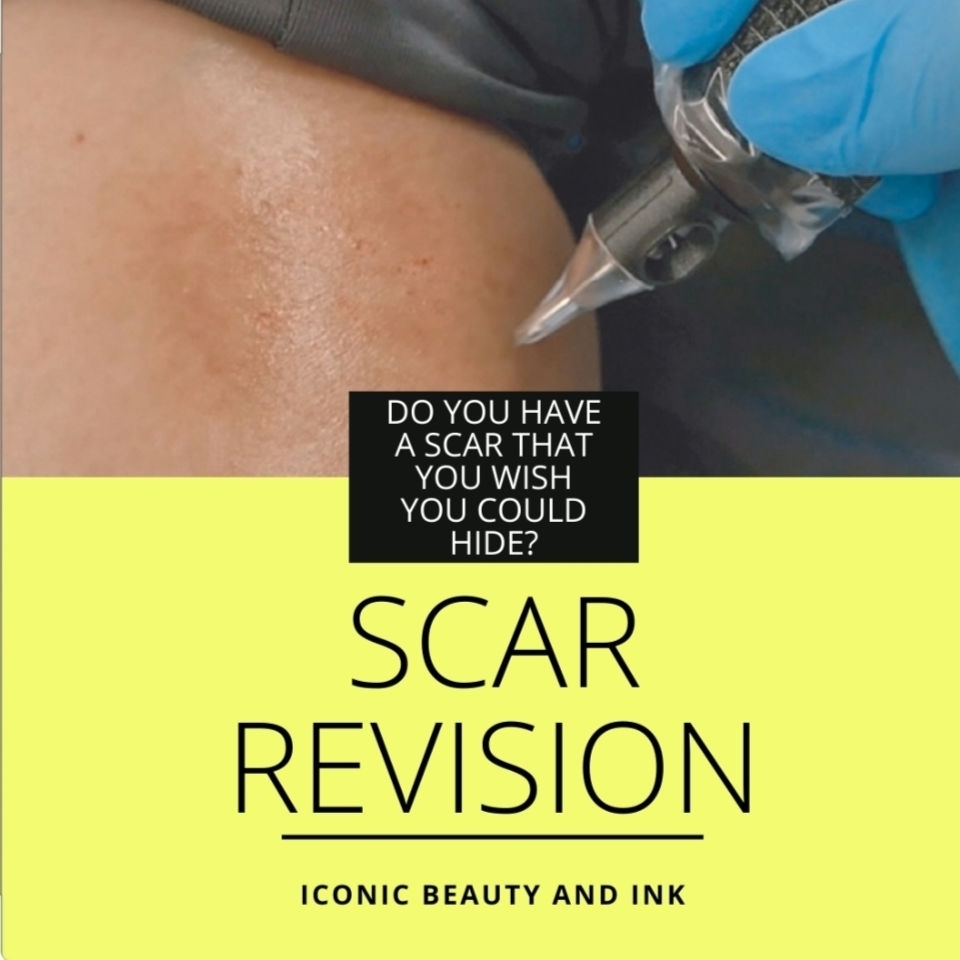 ๐ฆ Do you have scars that you would like to camofluage?โโโโโโโโ
Paramedical Tattooing can help!โโโโโโโโ
โโโโโโโโ
๐ฆ Stretchmarks, Burns, Scars, Skin Grafts, Surgical Scars, Self Harm Scars, and other skin traumas can be concealed by Skin Camouflaging.โ โโโโโโโโ
โ โโโโโโโโ
๐ฆ This can help you get rid of the painful reminders of your past and help you feel more confident!๐โโโโโโโโ
โโโโโโโโ
.โโโโโโโโ
.โโโโโโโโ
.โโโโโโโโ
.โโโโโโโโ
#Scars #camouflage #Paramedical #Tattoo #artist #tattooartist #Skin #burns #scarcamoflauging #tattoocoverup #Florida #transformation #floridaartist #facelift #faceliftscars #burncoverup #southflorida #fortlauderdale #parkland #pmu #pmuartist #feelbetter #byescars #self-harm #Bocaraton #confidence @iconicbeautyandink