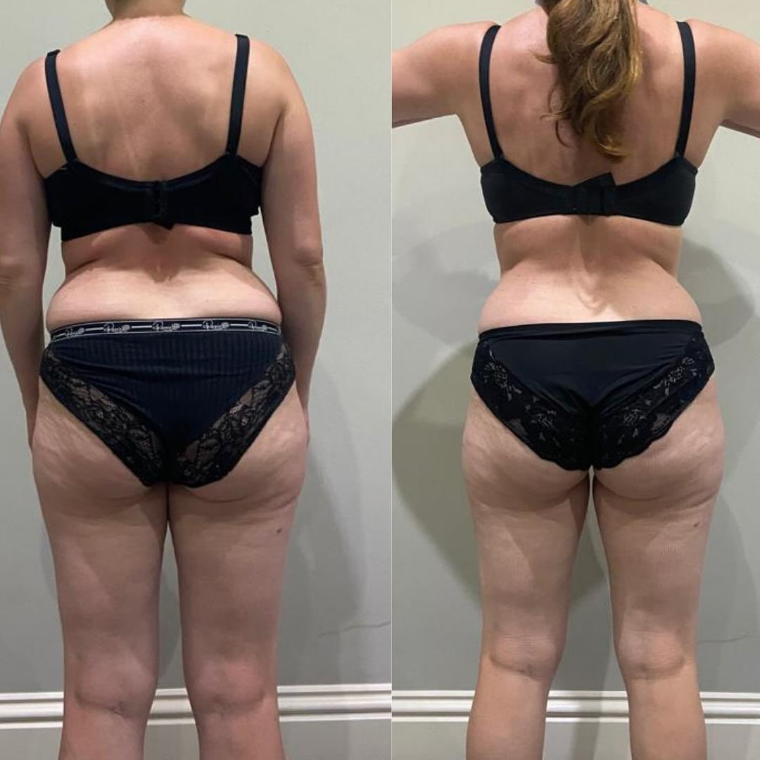 For your body
Acting simultaneously on the release of stubborn localised fat and skin quality (firmness, cellulite) the LPG treatment allows the body technology to act directly on the hypodermic cells. This layer primarily consists of adipose cells (fat cells), fibroblasts.
* Adipose cells (adipocytes): These cells store fat, which serves as an energy reserve, insulation, and cushioning for the body.
* Fibroblasts: These cells produce collagen, a protein that provides structure and support to the tissue.
A treatment that puts an end to the dilemma: slimming or firming??
To release stubborn fat and to look good this summer book your FREE consultation @serenityspaformby
#lpg #lpgendermologie® #lpgendermologie #lmphaticdrainage #wellbeing #skintreatment #skintightening #resistantfat #fatloss #fatlossjourney #beautysalon #northwest #formby #beautytips #serenityspaformby #bodyendermologie #cellulite #fatremoval #slimming #slimmingtreatment #firmingbody #bodyimprovement