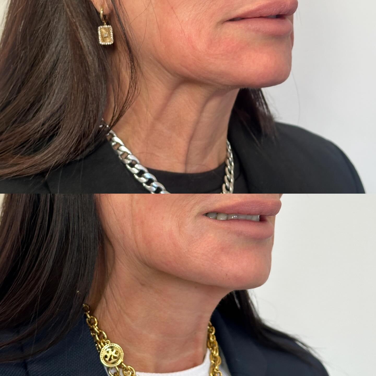 Probably one of the best add-ons to your treatment is Tox to the neck- quickly relax tension on the neck, lift the corners of the mouth, and lift the lower face. For the right candidate treatment also gives significant improvement to skin texture of the neck. Pair that with an unbelievable neck cream (shoutout to TECHNO neck) and you have a match made in heaven!
