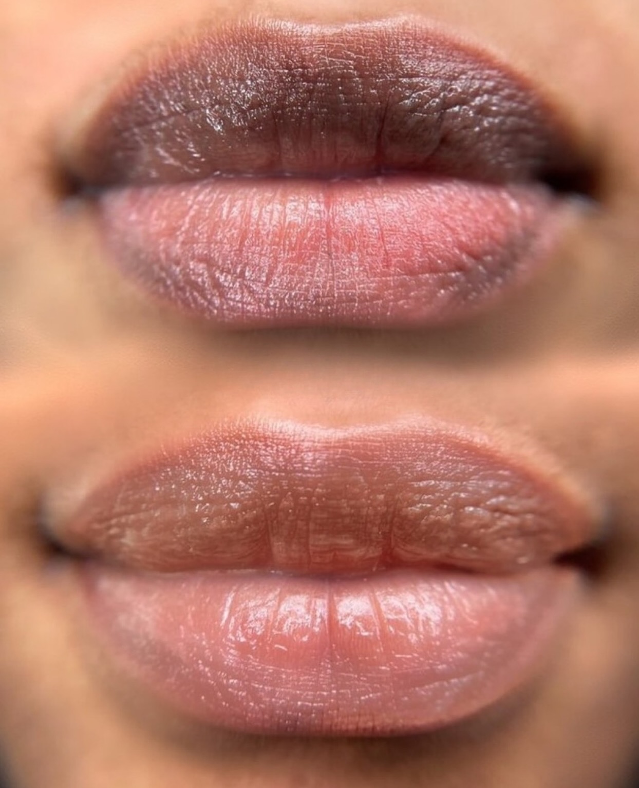 Lips neutralisation #shanghai #lipsneutralization