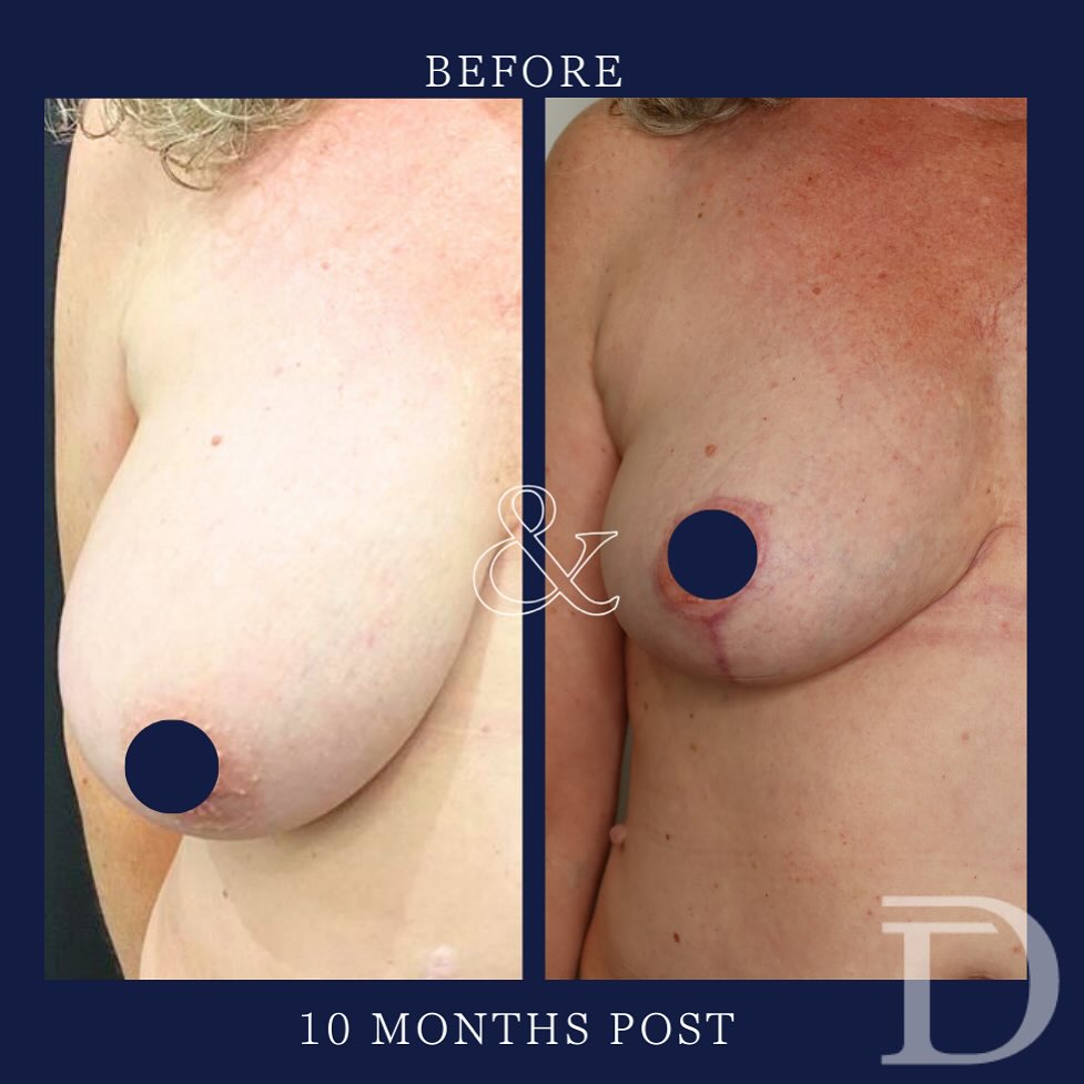 Breast Reduction
1 Pre Op 
2. 10 Months Post Op 
- Scars take 12-18 months to mature/ fade 
Surgery Performed by Dr Duncan Taylor (MED0001883464) Specialist Plastic & Reconstructive Surgeon.
🔹 Outcomes achieved in these photos are only relevant to this patient and do not necessarily reflect the results other patients may experience.
🔹There are inherent risks associated with any surgical or invasive procedures. The recovery period varies based on the specific procedure, and individual outcomes will differ.
🔹More information about risks and recovery for each procedure is available on our website www.drduncantaylor.com.au, on the procedure information sheets.
🔹We recommend getting a second opinion from a qualified health practitioner before proceeding.
🔹 This patient gave photo consent. 
#breastreduction #breastreductionperth #perthbreastreduction #breastreductionsurgery #perthplasticsurgeon #plasticsurgeonperth #plasticsurgeryperth #perthplasticsurgery #specialistplasticsurgeon