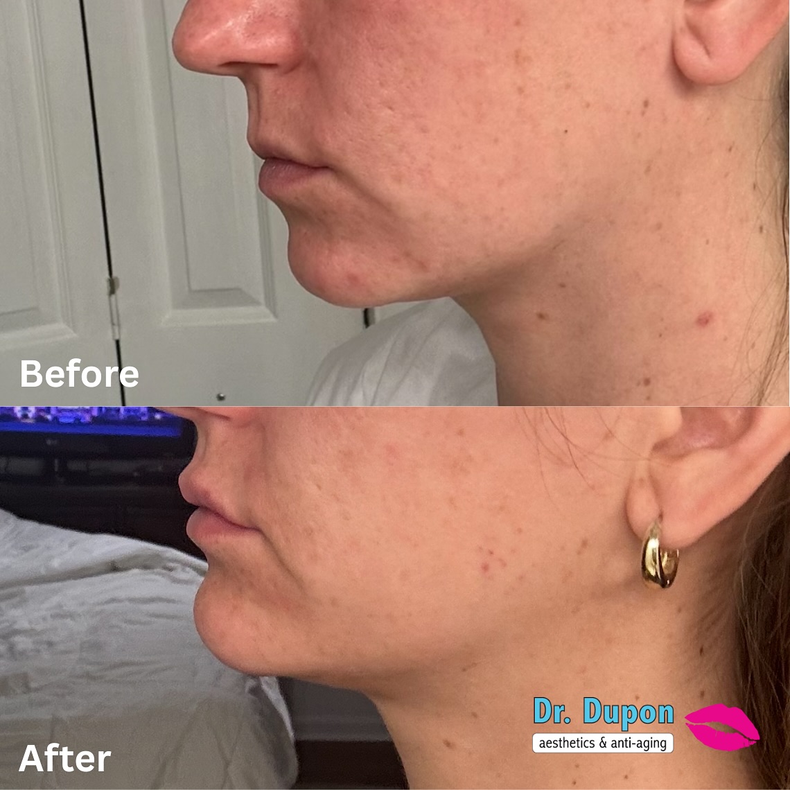 Subtle. Sculpted. Stunning.🤩
Check out this gorgeous before & after of lip and chin filler done by Dr. Dupon!
We love enhancing natural beauty with results that speak for themselves.
Ready for your transformation?
Message us today!
#ChinFiller #LipFiller #FacialBalancing #BeforeAndAfter #NaturalResults #DrDupon #LafayetteAesthetics #ConfidenceBoost #AestheticMedicine #BatonRouge #Lafayette