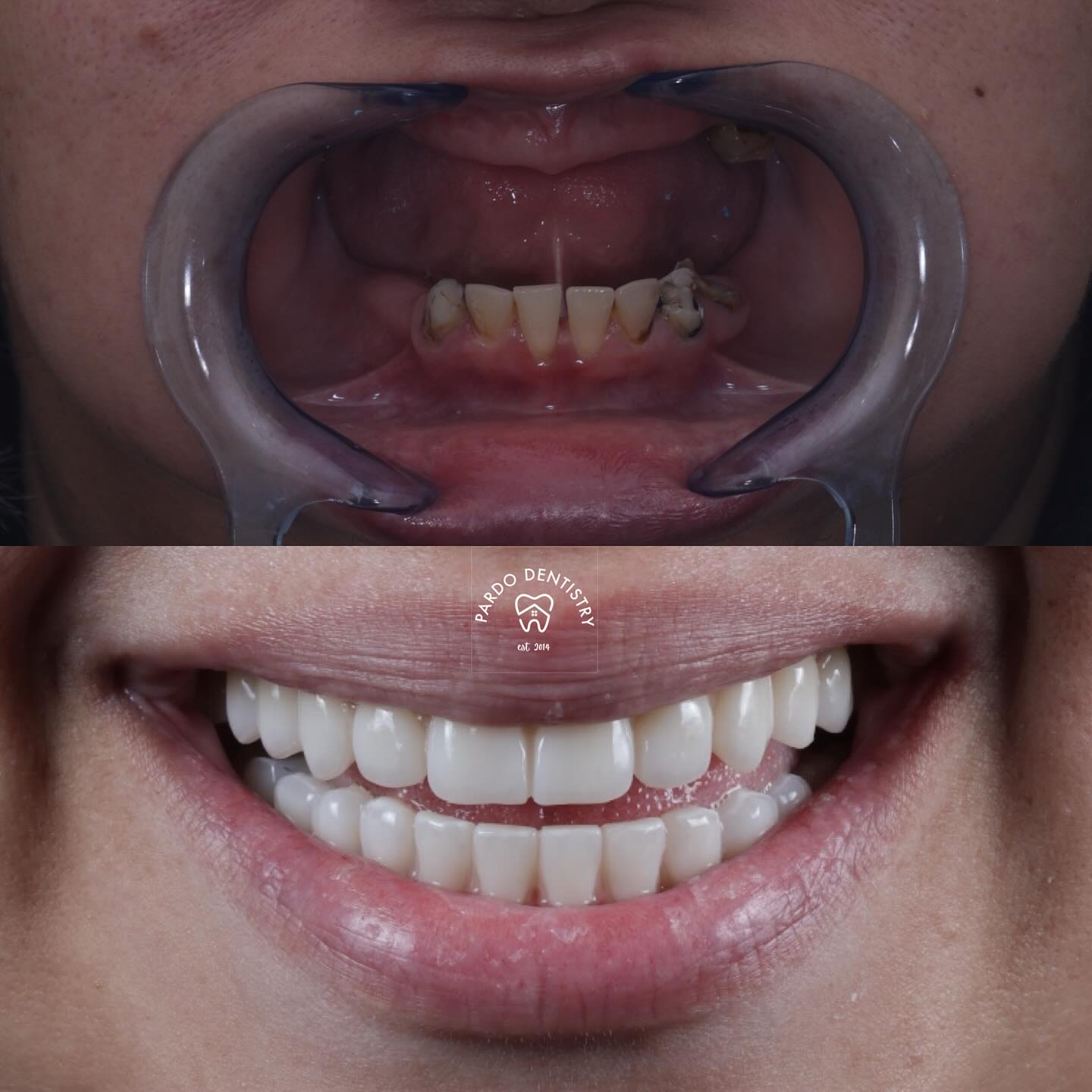 #allonxdentalimplants
A life changing solution for failing teeth or removable dentures.
The “All-on-X” concept refers to the strategic placement of a specific number (X) of dental implants—usually 4 to 6—within the jawbone to support a full arch of prosthetic teeth. Unlike traditional dentures, which rest on the gums and often rely on adhesives, All-on-X dentures are permanently fixed in place and anchored by titanium implants that integrate with the jawbone through a process called osseointegration.
At Pardo Dentistry, we are proud to offer All-on-X implant-supported dentures, a transformative treatment for patients suffering from failing dentition—whether due to advanced decay, damaged teeth, or extensive tooth loss. This advanced solution features a permanently fixed, non-removable prosthesis that restores full function, comfort, and aesthetics—dramatically improving quality of life.
Call us for a consultation today if you know someone that would improve their quality of life with this procedure!