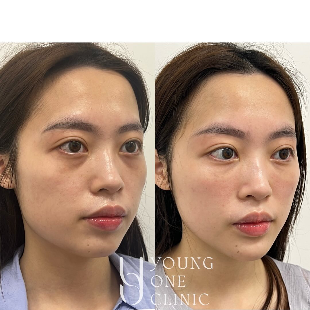 Love how my client looks more rested, and more balanced. The results are natural and subtle.
Thank you to all my patients who trust and let me post your results ❤️ I’m so grateful!
Welcome to book in a consultation to know more about:
- Lips enhancement
- under-eye rejuvenation
- Facial balancing/ contouring
- Wrinkle reduction
- Face slimming
- Bruxism/ teeth clenching
Disclaimer: All images used with consent. Individual results vary. Always seek advice from a qualified medical professional. A thorough consult is required for suitability, risks, side effects, procedure, options and aftercare. Any cosmetic or invasive procedure carries risk.
#brisbane #brisbanebeauty #brisbanelips #chin #teartrough #masseter #masseterreduction #faceslimming