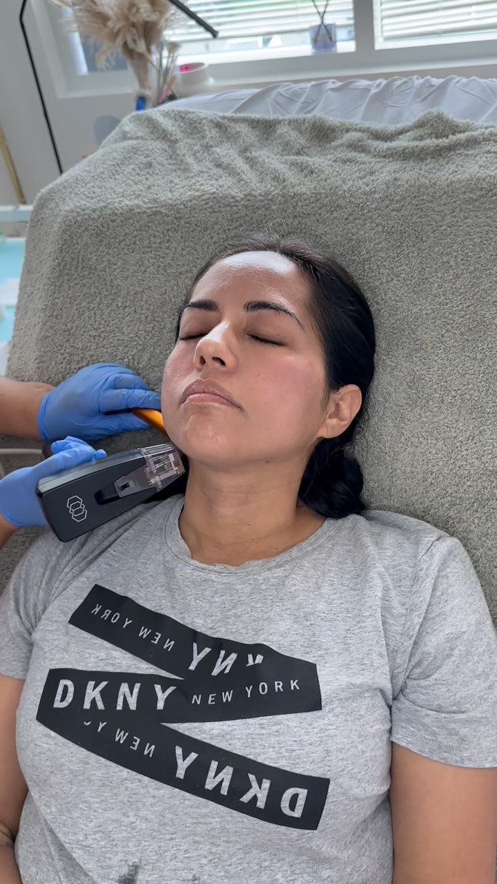 A little Morpheus8 moment — smoother skin and a fresh glow incoming! ✨😮💨
Call 📱 Vital Health and Aesthetics at 571-707-8518 to book your appointment!”
#Morpheus8 #SkinTightening #GlowUp #FacialRejuvenation #VitalHealthAndAesthetics #BeautyBoost #NonSurgicalLift #SkincareGoals