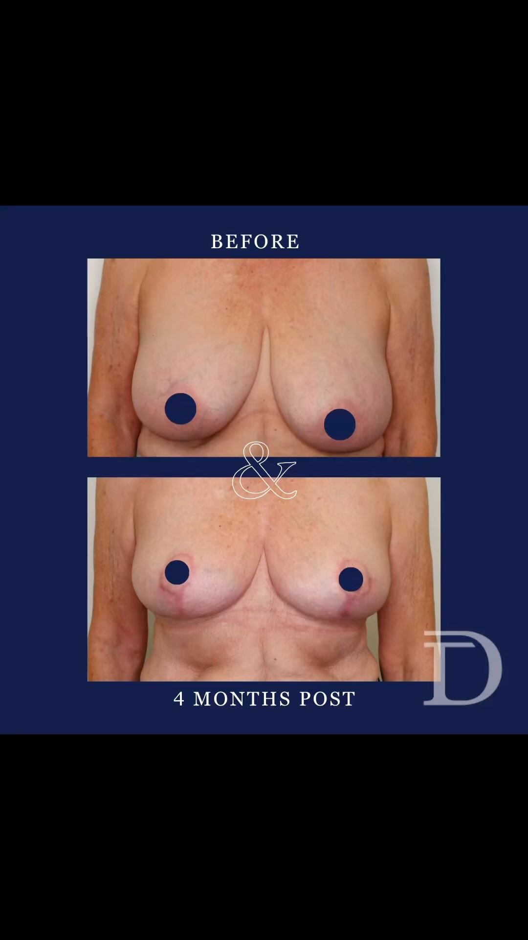 Breast Reduction
1. Pre Op 
2. 4 Months Post Op 
- Scars take 12-18 months to mature/ fade 
Surgery Performed by Dr Duncan Taylor (MED0001883464) Specialist Plastic & Reconstructive Surgeon.
🔹 Outcomes achieved in these photos are only relevant to this patient and do not necessarily reflect the results other patients may experience.
🔹There are inherent risks associated with any surgical or invasive procedures. The recovery period varies based on the specific procedure, and individual outcomes will differ.
🔹More information about risks and recovery for each procedure is available on our website www.drduncantaylor.com.au, on the procedure information sheets.
🔹We recommend getting a second opinion from a qualified health practitioner before proceeding.
🔹 This patient gave photo consent. 
#bilateralbreastreduction #breastreductionsurgery #perthbreastreduction #breastreductionperth #breastsurgeryperth #perthbreastsurgery #perthplasticsurgeon #plasticsurgeonperth #plasticsurgeryperth #perthplasticsurgery #specialistplasticsurgeon #cosmeticsurgeryperth #perthcosmeticsurgery #breastliftperth #perthbreastlift