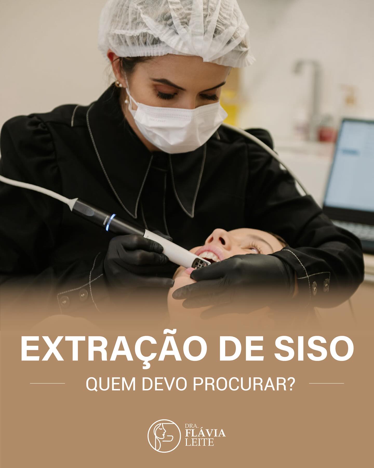 A extração dos terceiros molares, ou popularmente conhecido como siso, é indicada em várias situações clínicas.
•Uma das indicações mais importantes é para evitar quadros recorrentes de pericoronarite, que é a inflamação ao redor da coroa do dente. Se essa inflamação for infecciosa e não tratada adequadamente, pode, em casos extremos, levar ao óbito.
•Além disso, a extração pode ser necessária por motivos ortodônticos e protéticos.
•Para prevenir o desenvolvimento de cistos e tumores odontogênicos, prevenir cáries, doenças periodontais, e reabsorção radicular no dente adjacente.
•Nos casos em que se opta por manter um terceiro molar não irrompido ou parcialmente irrompido, é recomendada uma vigilância clínica e radiográfica ativa ao longo da vida para monitorar possíveis complicações. #dentista #dentesiso #siso #cirurgia #odonto