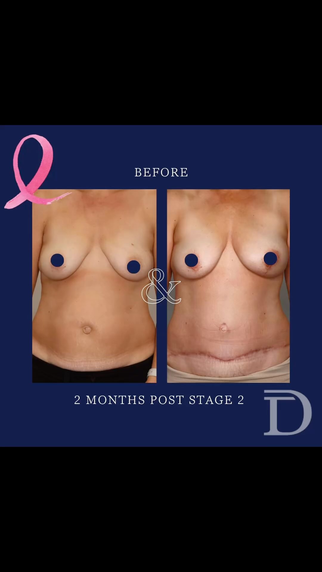 Left Nipple Sparing Mastectomy + Immediate DIEP Breast Reconstruction 
1. Pre Op 
2. 2 Months Post Stage 2
- Surgery 1 - Unilateral Nipple Sparing Mastectomy + SLNB performed by Breast Surgeon + Immediate DIEP Breast Redconstruction. When keeping the nipple, a small paddle of skin from the abdomen remains attached under the nipple, to monitor the free tissue transfer. 
- Surgery 2 - (minimum 3-4 months post) - monitoring skin paddle removed + fat grafting to smooth out contour on breasts/ abdomen - Scars take 12-18 months to mature/ fade
Surgery Performed by Dr Duncan Taylor (MED0001883464) Specialist Plastic & Reconstructive Surgeon.
🔹 Outcomes achieved in these photos are only relevant to this patient and do not necessarily reflect the results other patients may experience.
🔹There are inherent risks associated with any surgical or invasive procedures. The recovery period varies based on the specific procedure, and individual outcomes will differ.
🔹More information about risks and recovery for each procedure is available on our website www.drduncantaylor.com.au, on the procedure information sheets.
🔹We recommend getting a second opinion from a qualified health practitioner before proceeding.
🔹 This patient gave photo consent. 
#nipplesparingmastectomy #unilateralmastectomy #autologousbreastreconstruction #diepsurgery #breastreconstruction #breastreconstructionawareness #perthbreastcancer #breastcancerperth #perthbreastreconstruction #breastreconstructionperth #plasticsurgeryperth #perthplasticsurgery #specialistplasticsurgeon #perthplasticsurgeon #plasticsurgeonperth