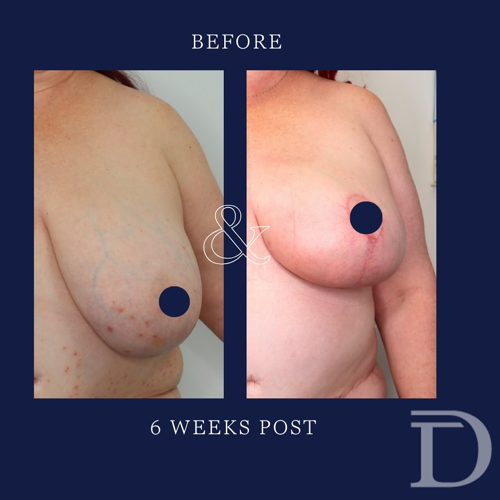 Breast Reduction 
1. Pre Op 
2. 6 Weeks Post Op 
- This patient wanted a small reduction/ lift 
- Scars take 12-18 months to mature/ fade 
Surgery Performed by Dr Duncan Taylor (MED0001883464) Specialist Plastic & Reconstructive Surgeon.
🔹 Outcomes achieved in these photos are only relevant to this patient and do not necessarily reflect the results other patients may experience.
🔹There are inherent risks associated with any surgical or invasive procedures. The recovery period varies based on the specific procedure, and individual outcomes will differ.
🔹More information about risks and recovery for each procedure is available on our website www.drduncantaylor.com.au, on the procedure information sheets.
🔹We recommend getting a second opinion from a qualified health practitioner before proceeding.
🔹 This patient gave photo consent. 
#breastreduction #breastreductionperth #perthbreastreduction #perthplasticsurgery #plasticsurgeryperth #plasticsurgeonperth #perthplasticsurgeon #breastsurgeryperth #specialistsplasticsurgeon