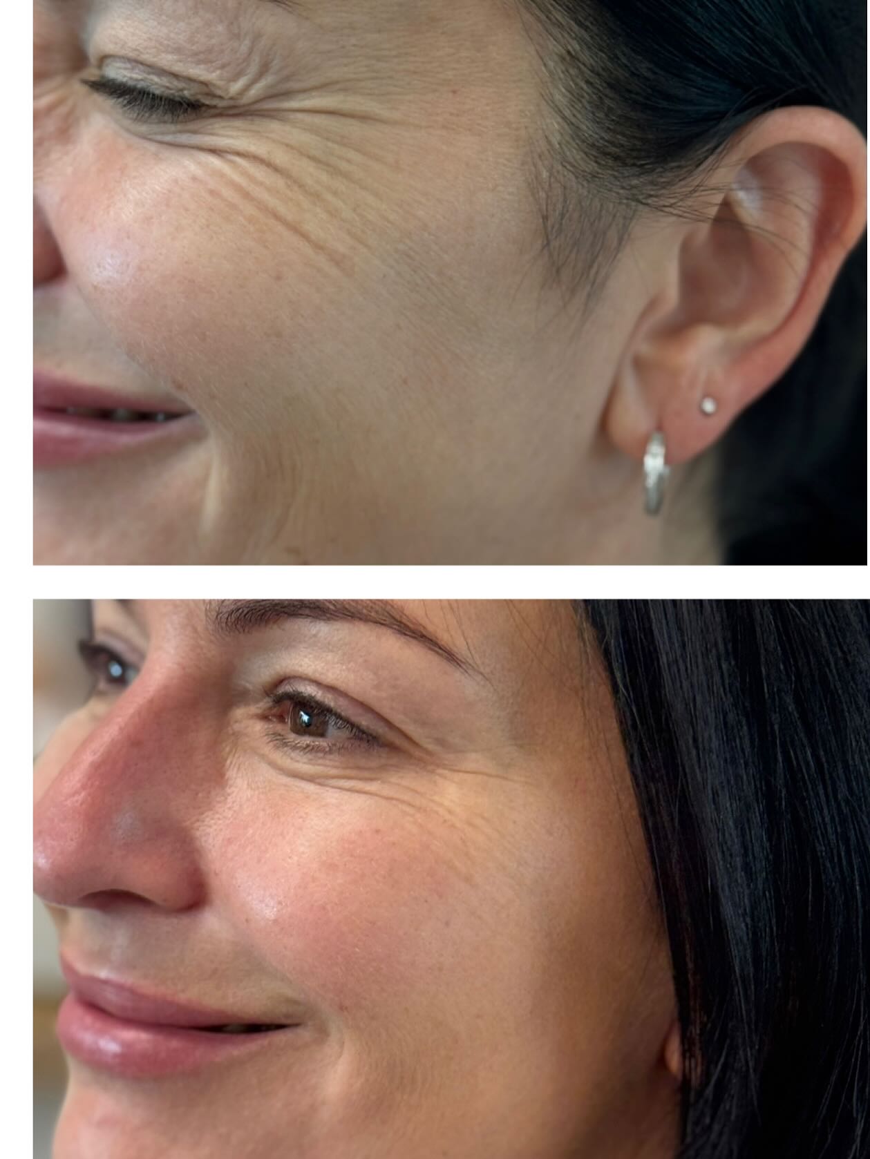 Skinvive by Juvéderm delivers a boost of hydration that smooths, plumps, and restores that lit-from-within glow — even in delicate areas like under the eyes ✨✨✨
.
📸 Before & After: Notice the softened fine lines, improved texture, and subtle radiance. No filters. Just Skinvive. ✨
.
#cloudnineclinic #juvederm #restylane #reclaiming #botoxcosmetic #botoxhighlandsranch #dysport #skinvive
.
Cloud Nine Clinic: Medical Spa
9330 S University Blvd. suite 220
Highlands Ranch Co 80129
720 360 5383 (call or text)